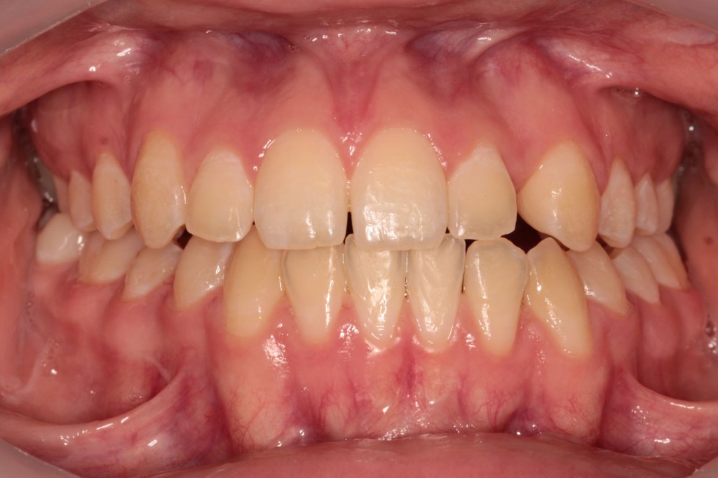 Mandibular laterognathia
