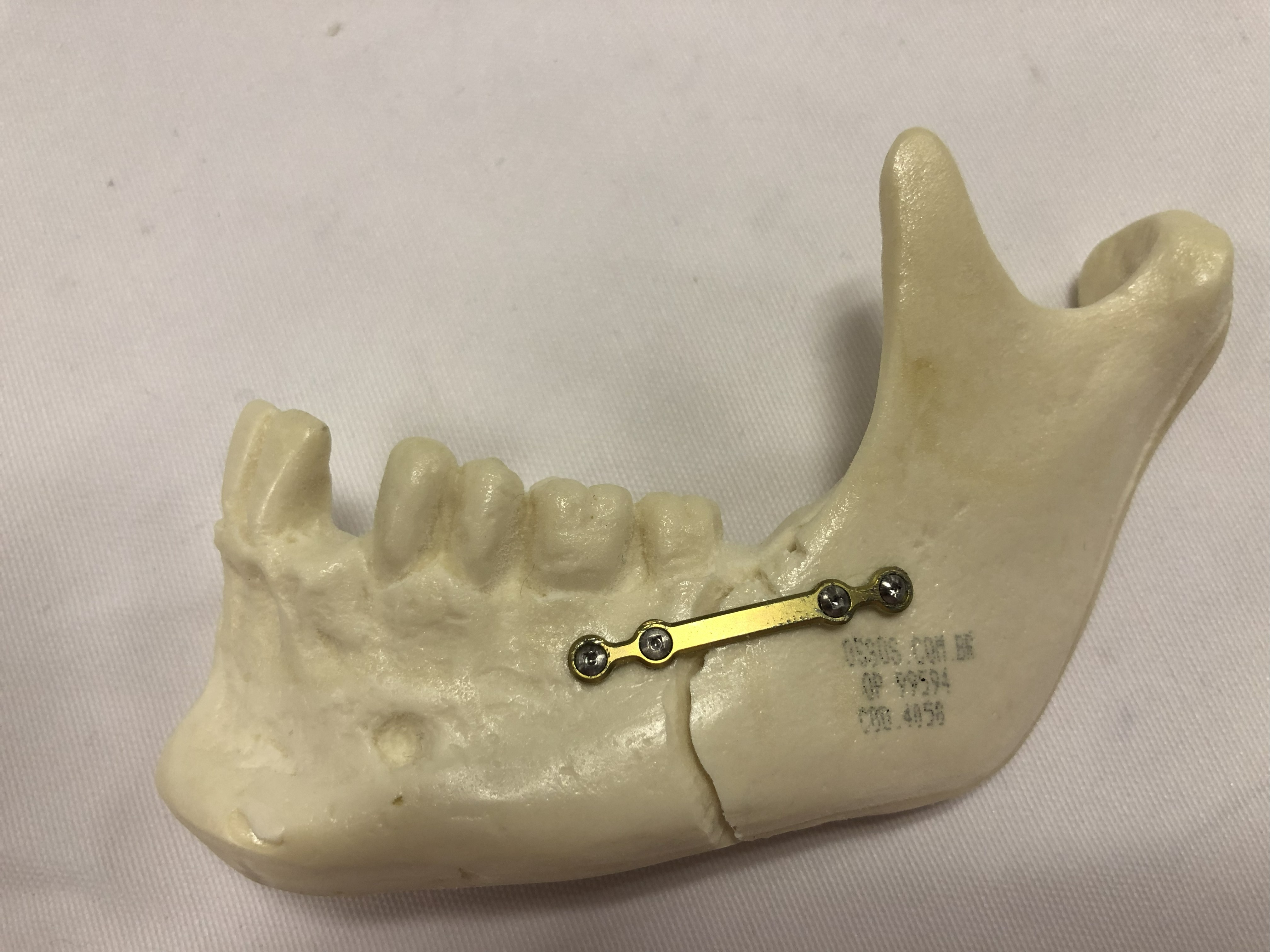 Material de osteosíntesis