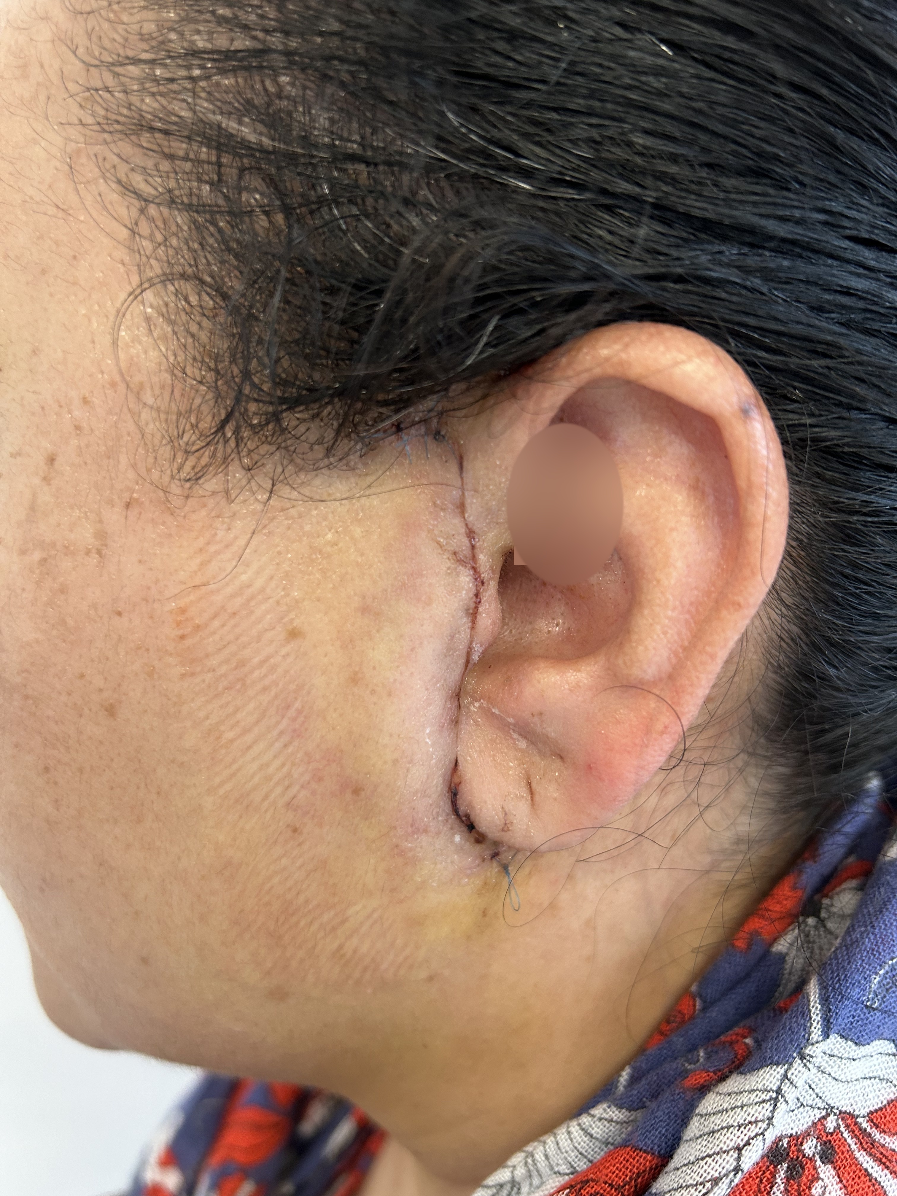 Case: Adenoma