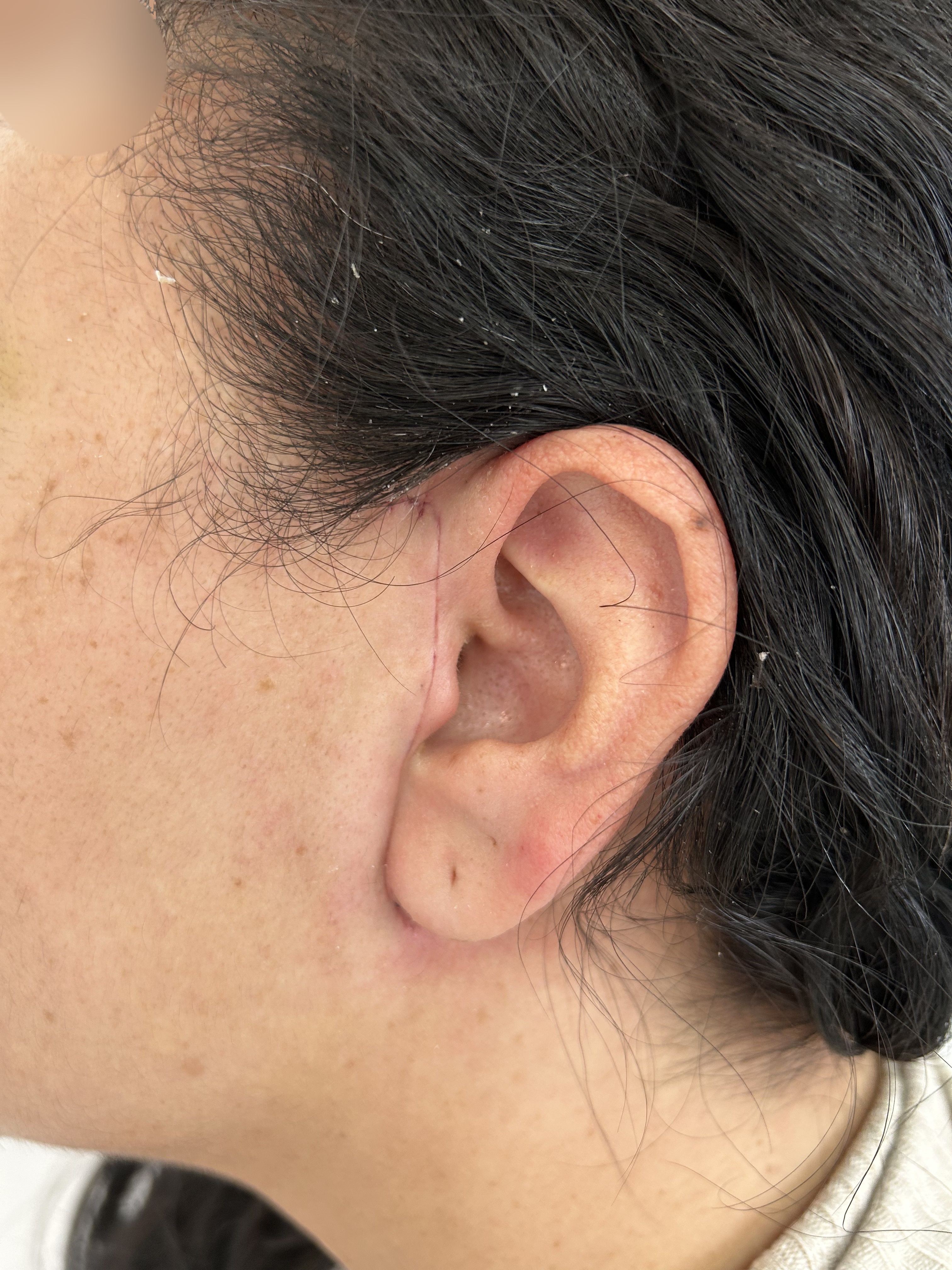 Case: Adenoma