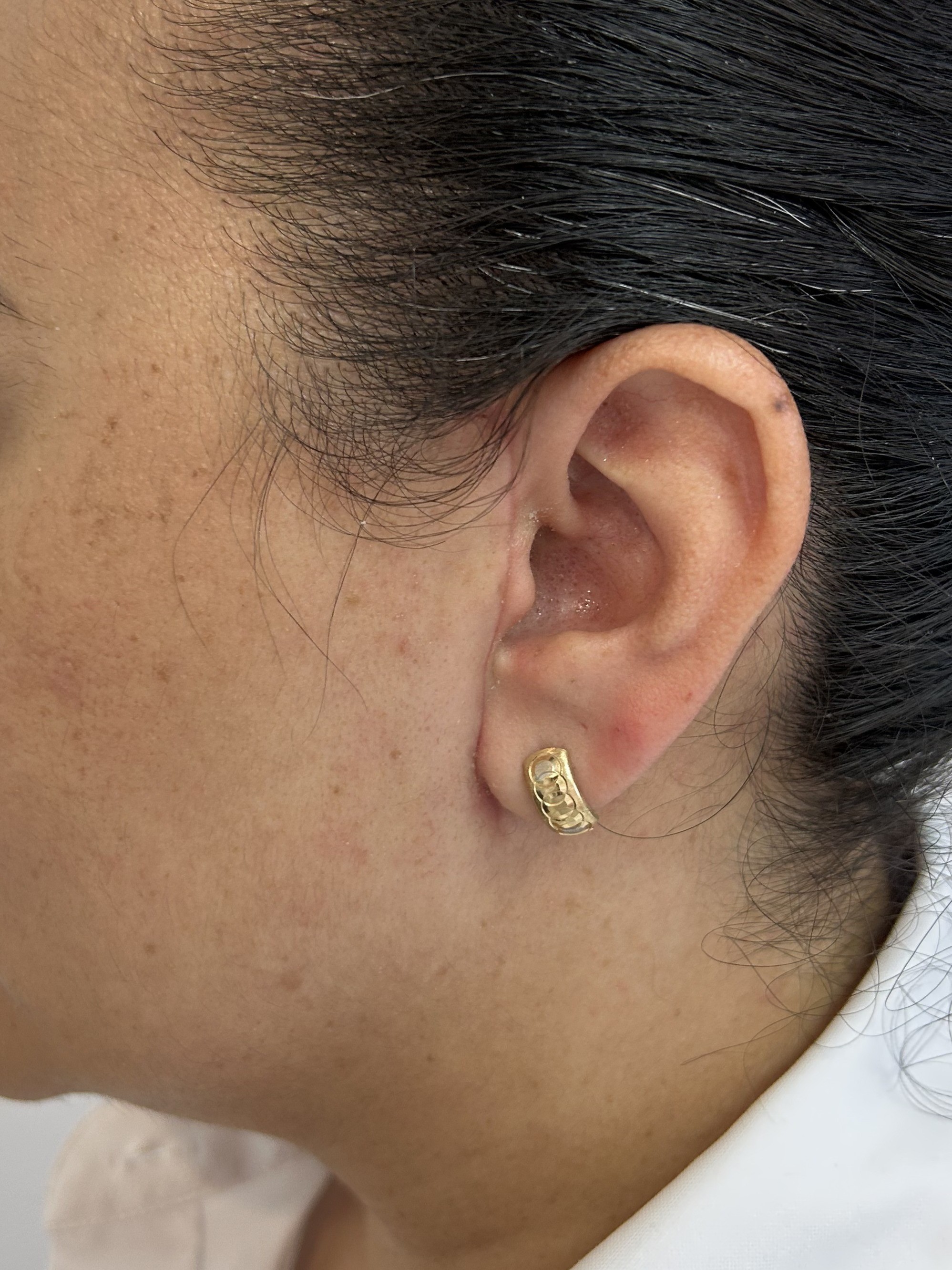 Case: Adenoma