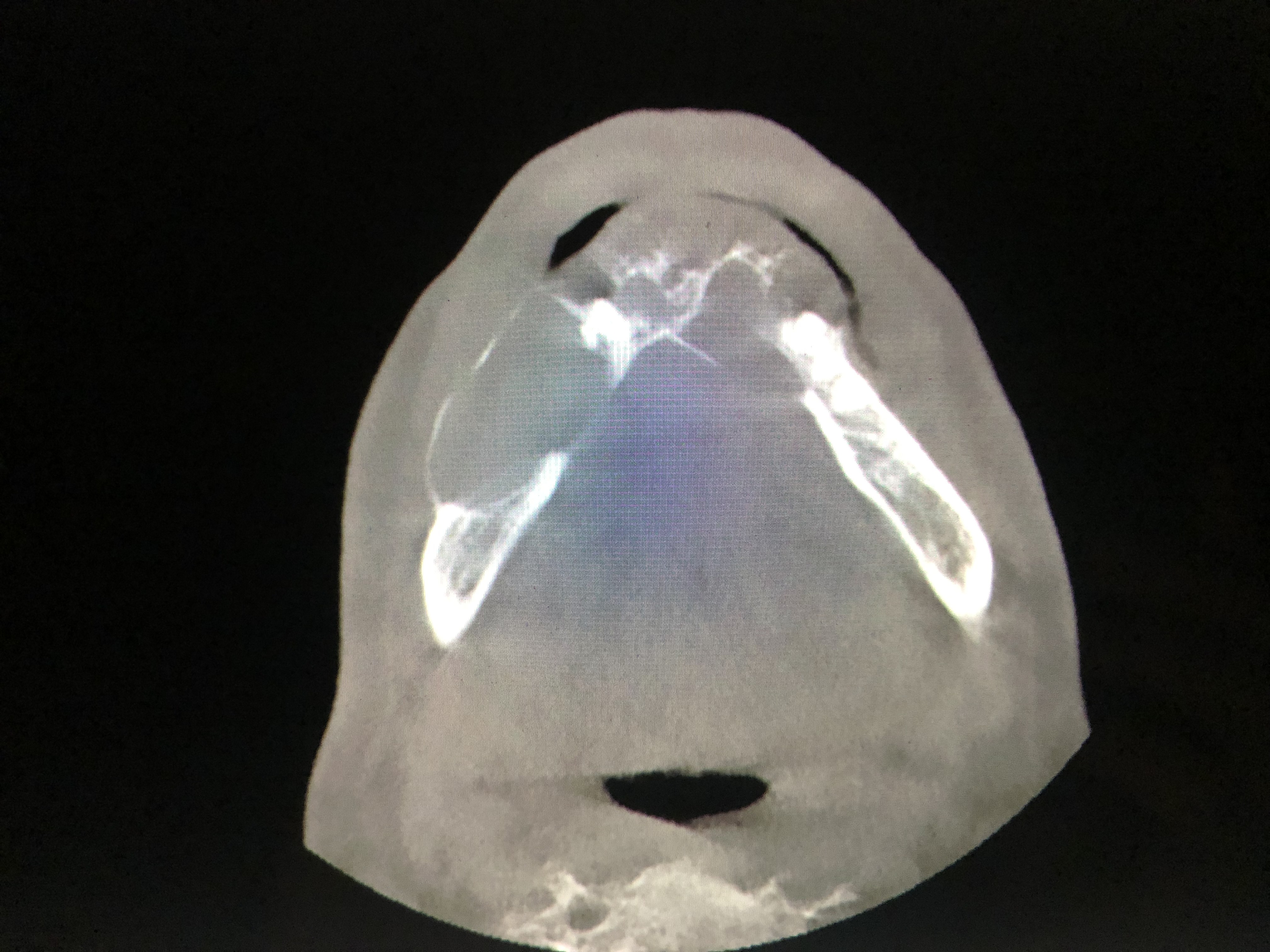 Caso: Ameloblastoma