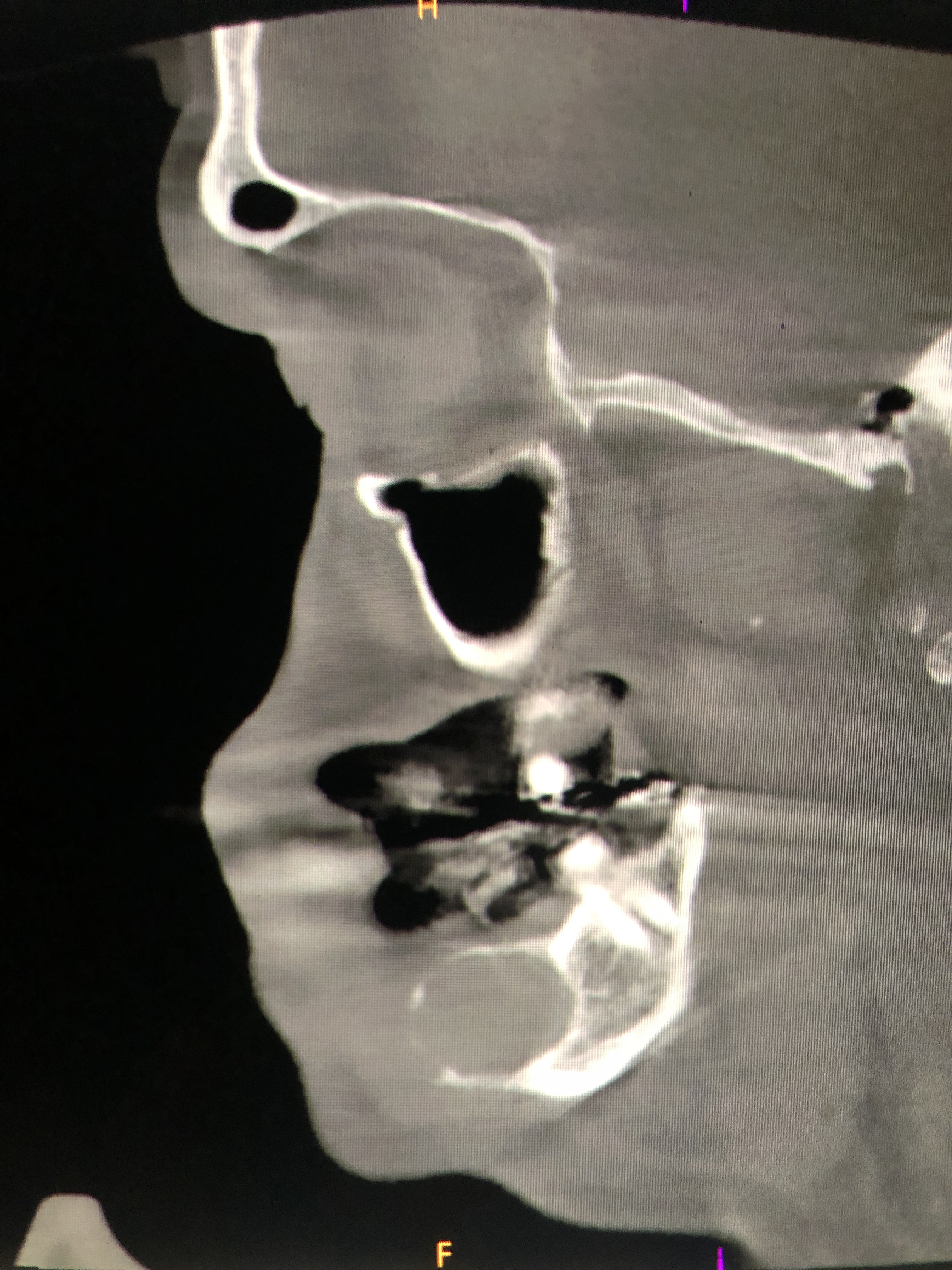 Caso: Ameloblastoma