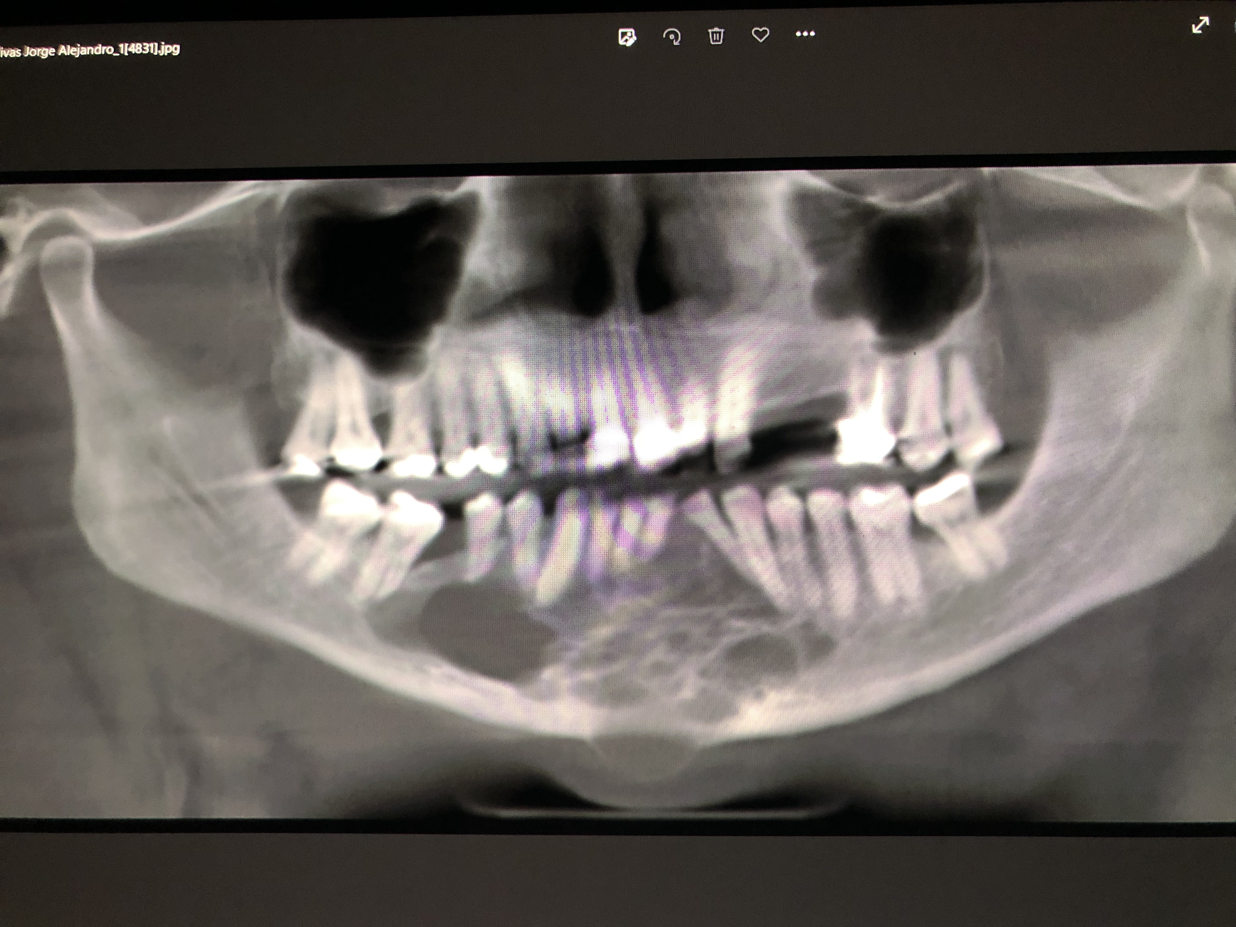 Caso: Ameloblastoma