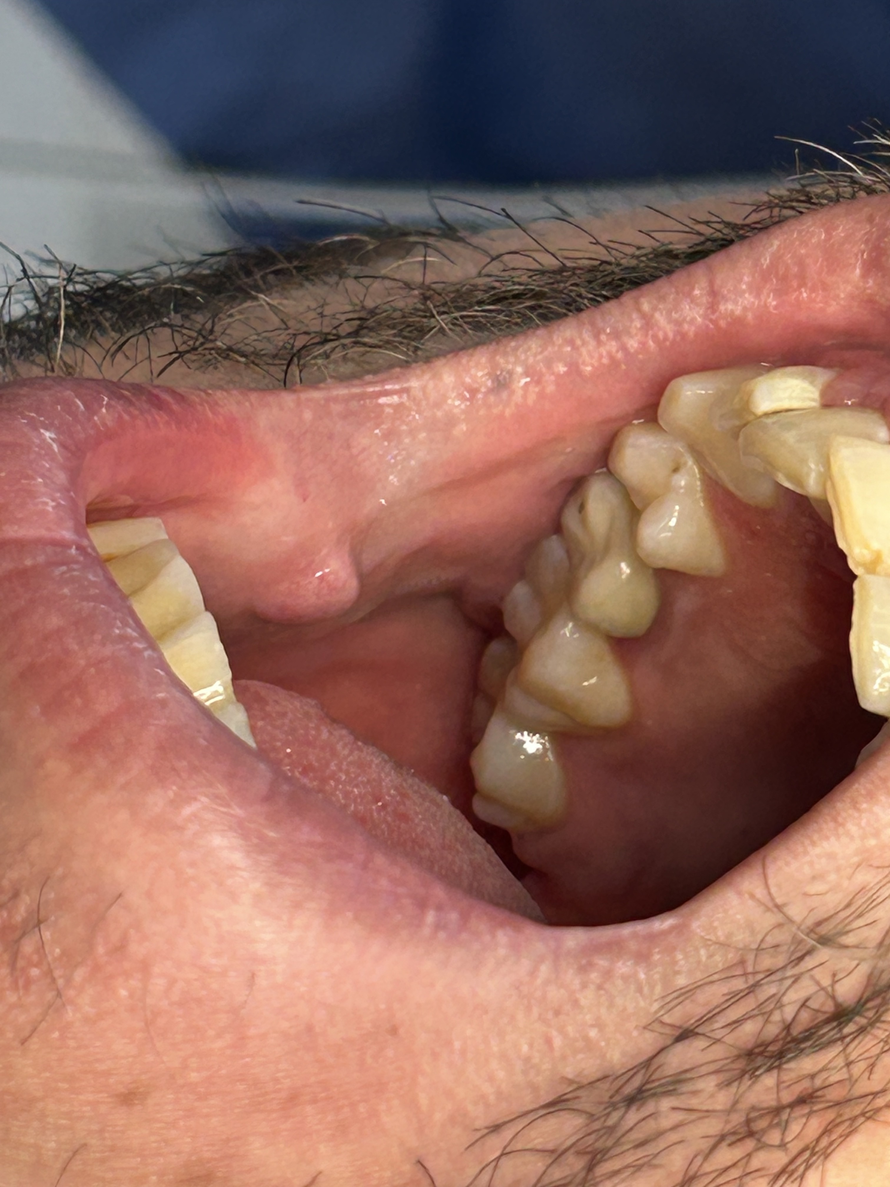 Fibroma con Láser