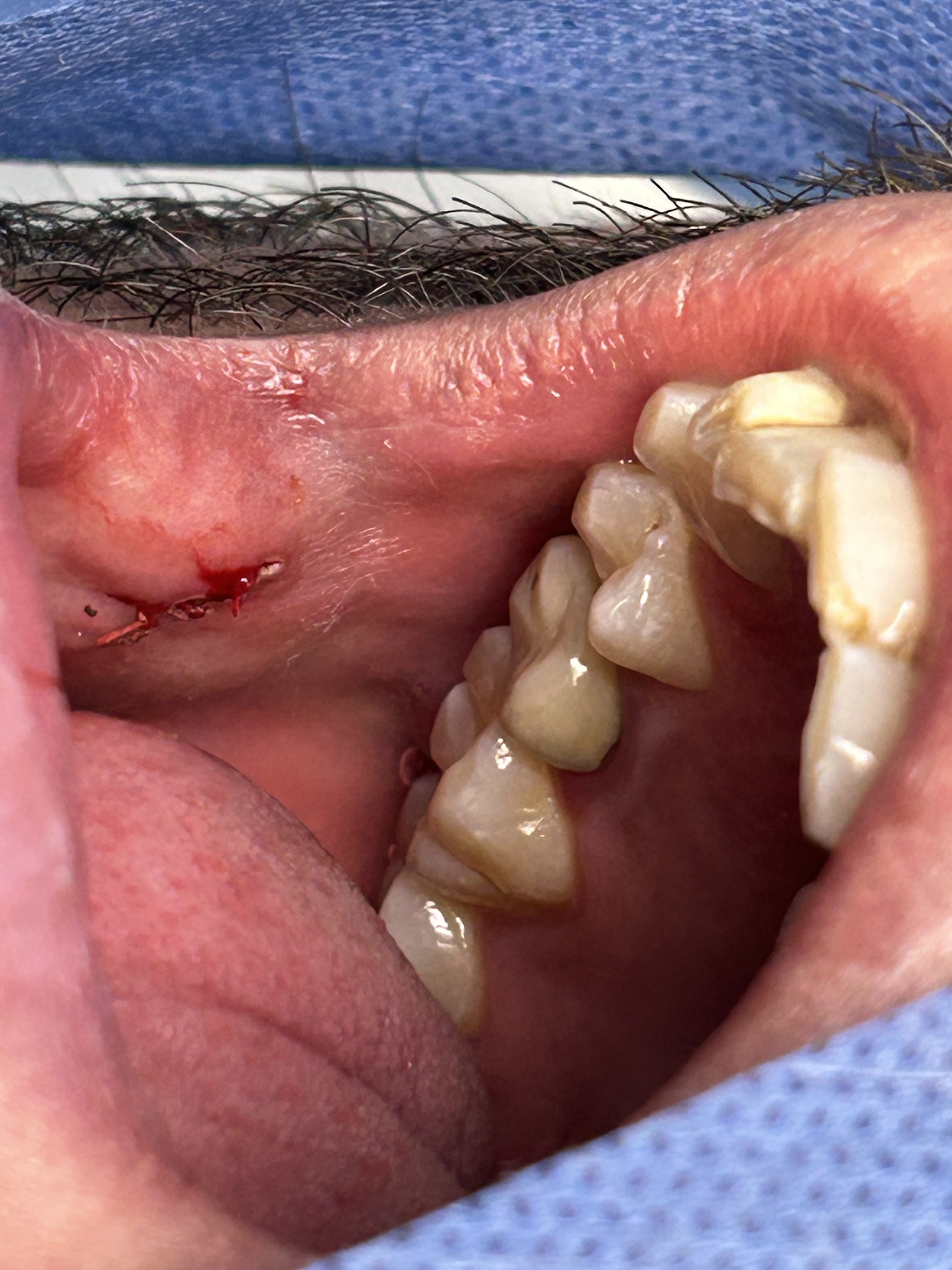 Fibroma con Láser