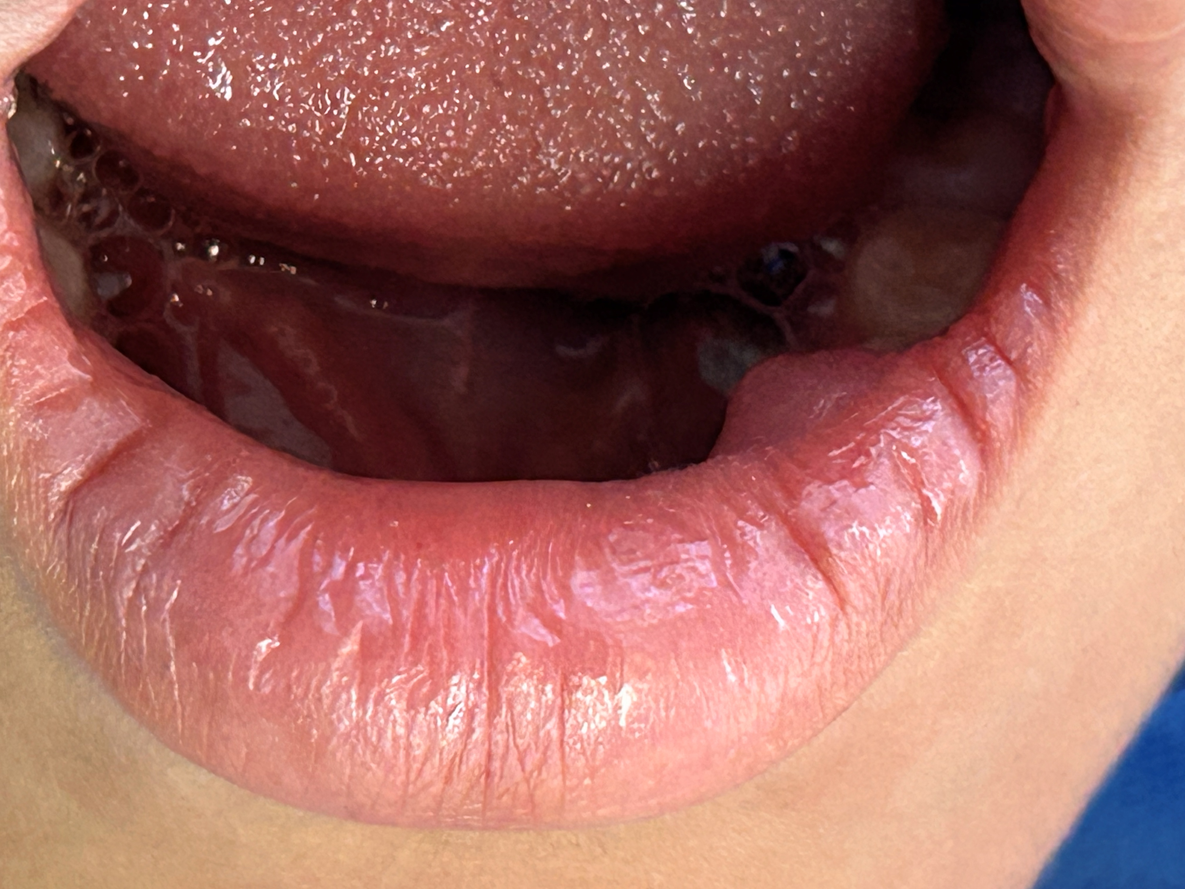 Mucocele (clinical case)