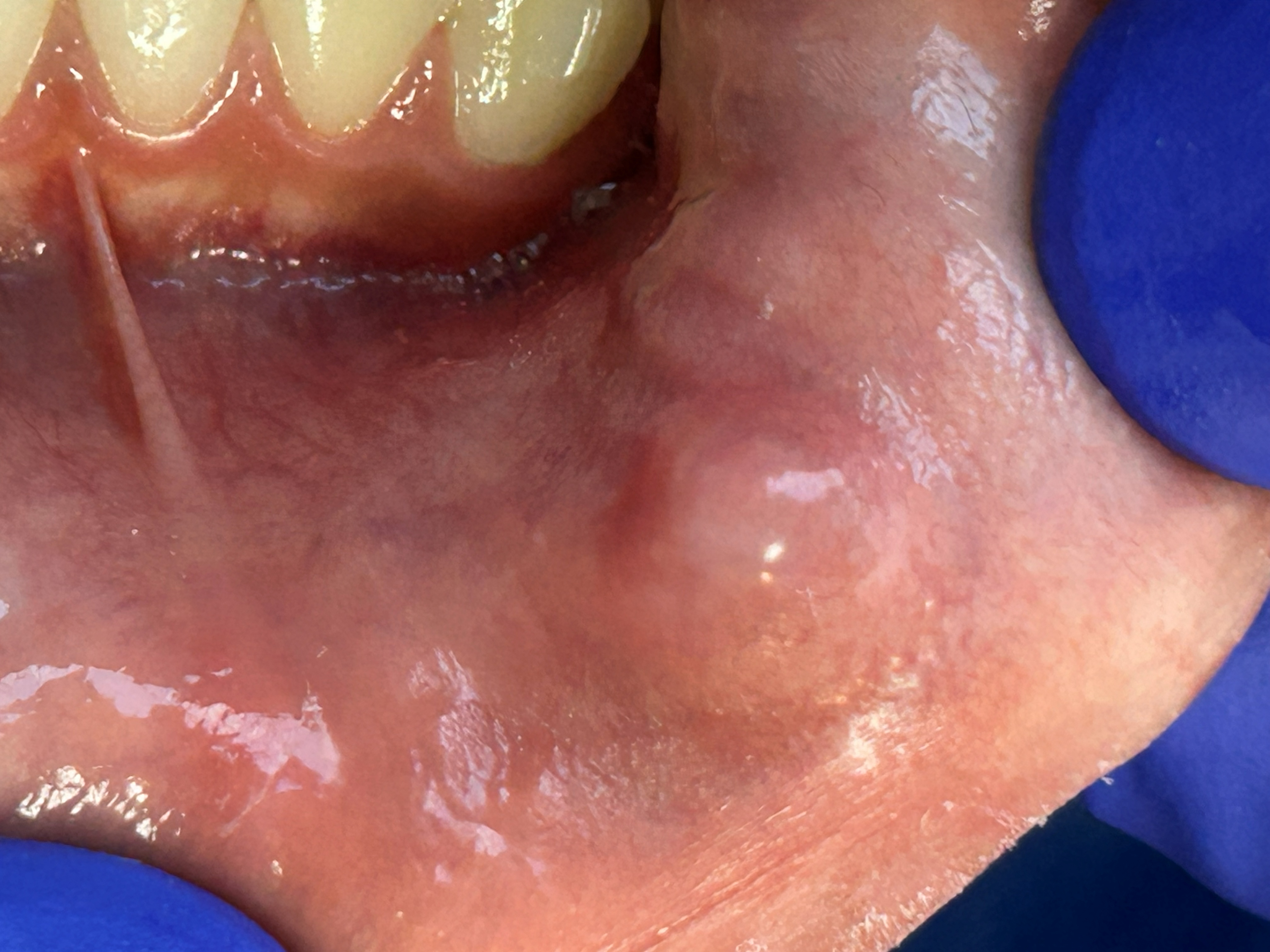 Mucocele (clinical case)