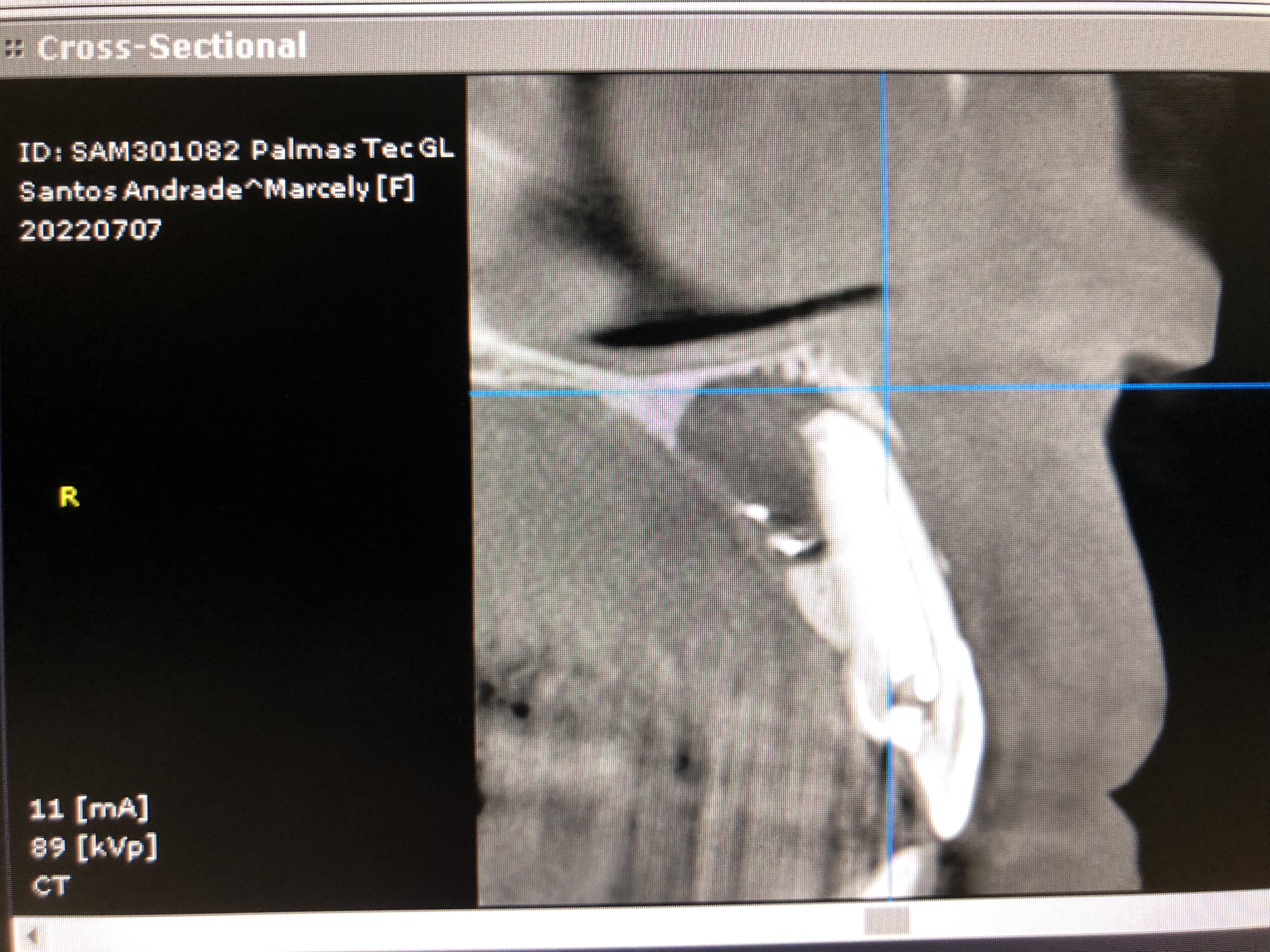 Caso: Quiste periapical