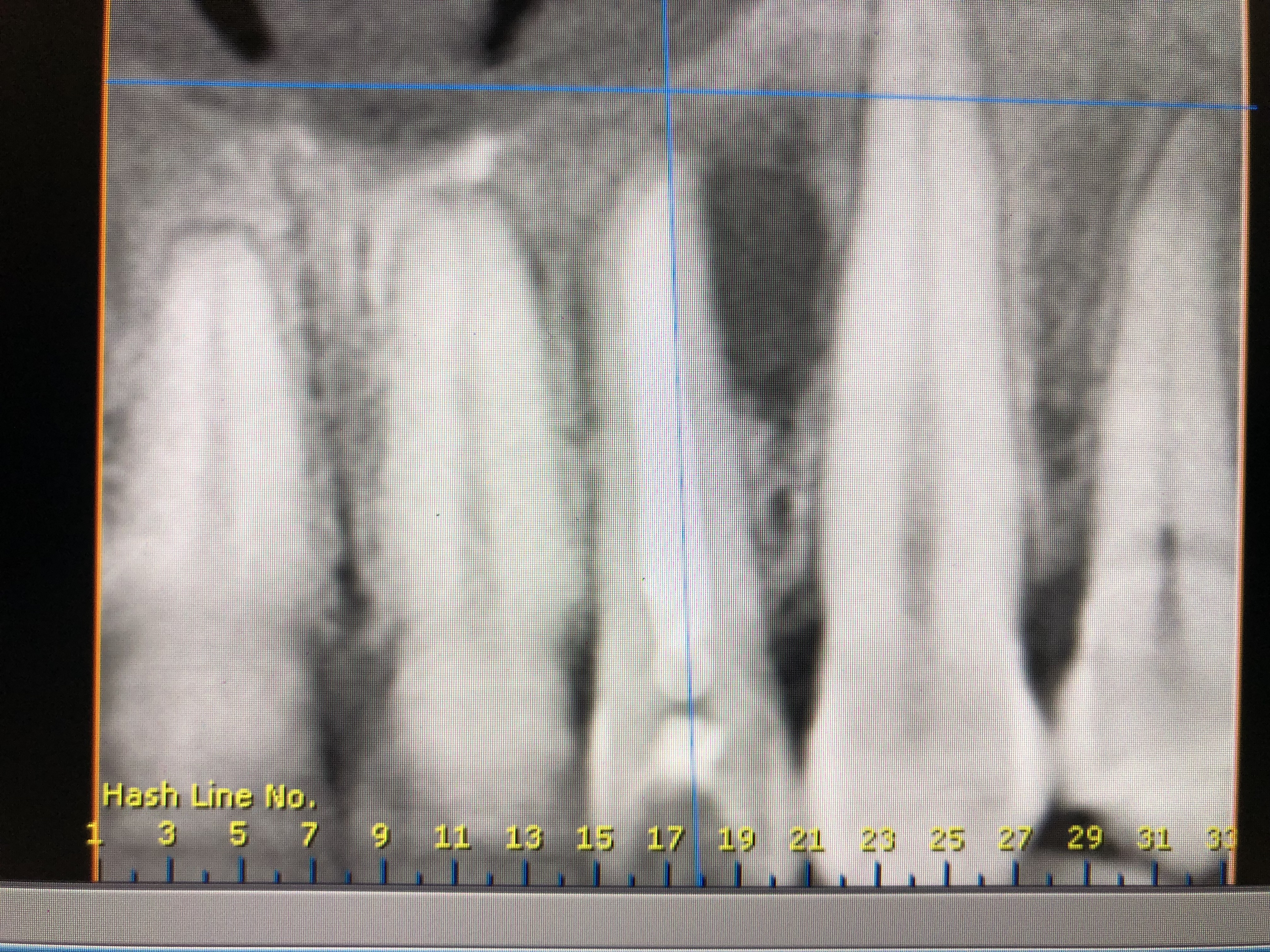 Caso: Quiste periapical