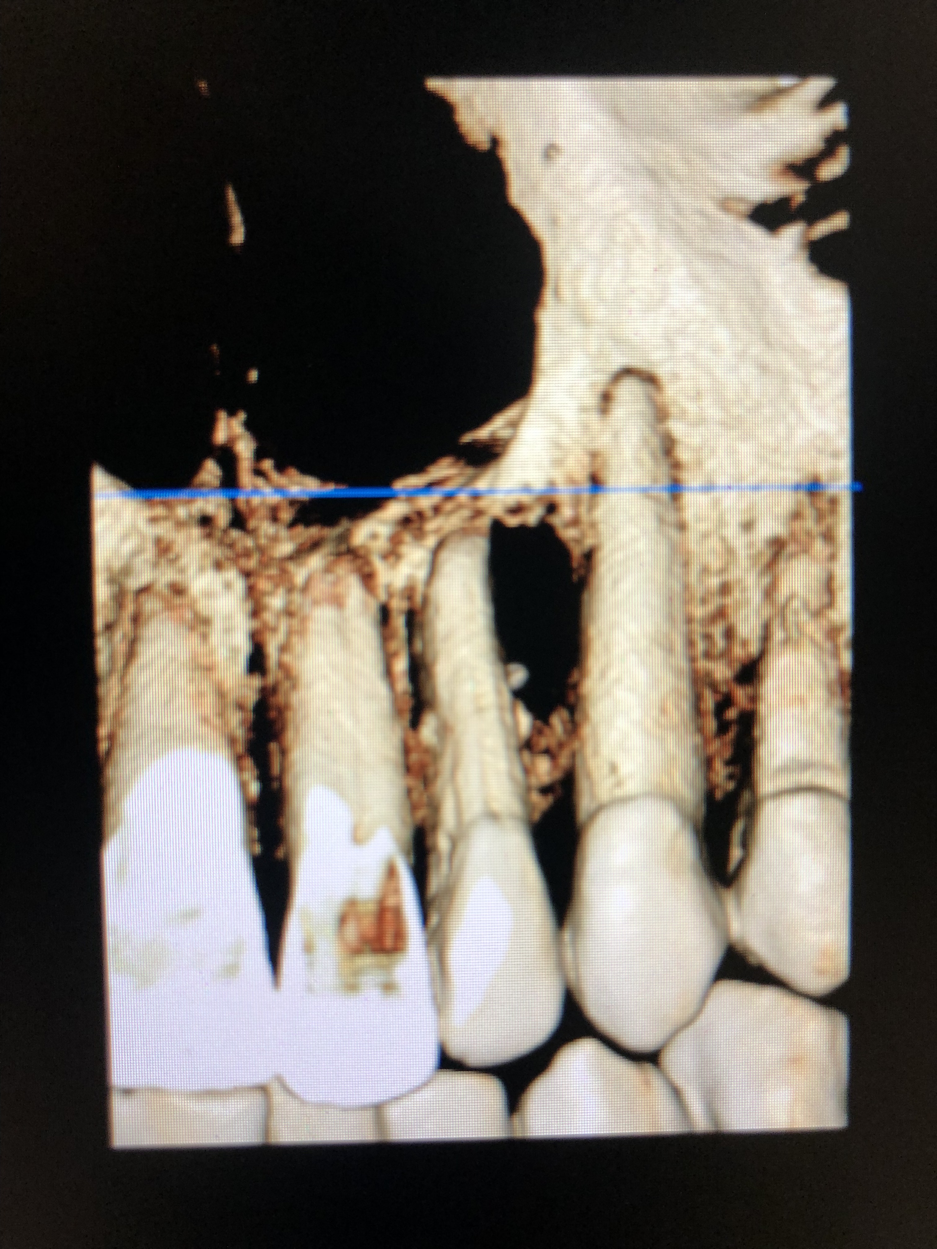 Caso: Quiste periapical