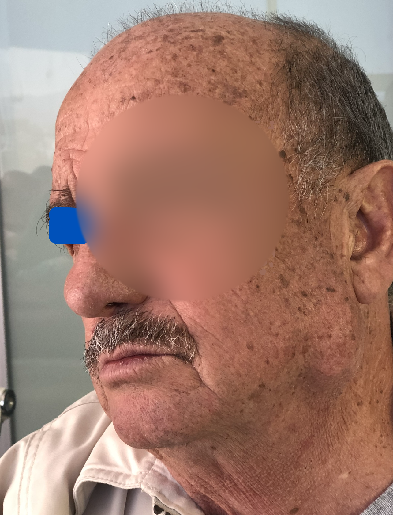 Case: Parotid Tumor