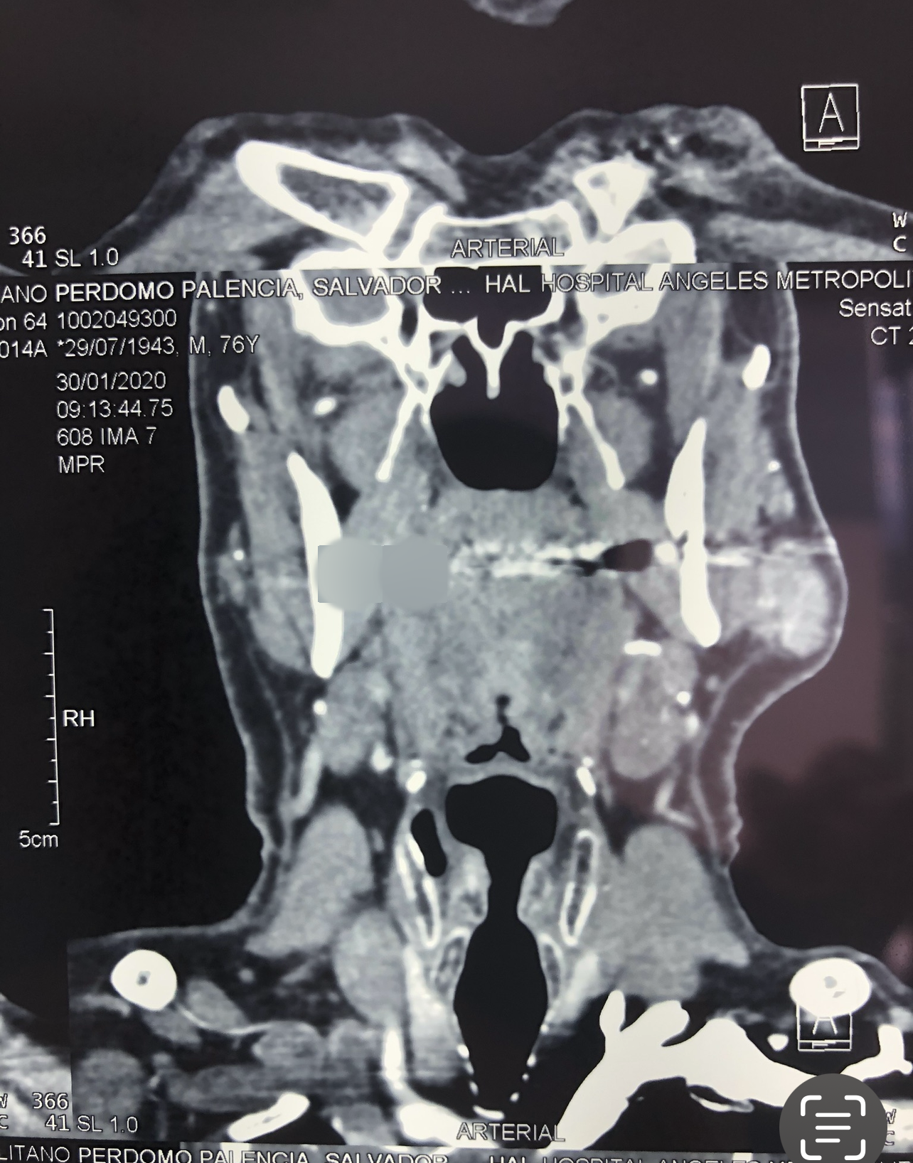 Case: Parotid Tumor