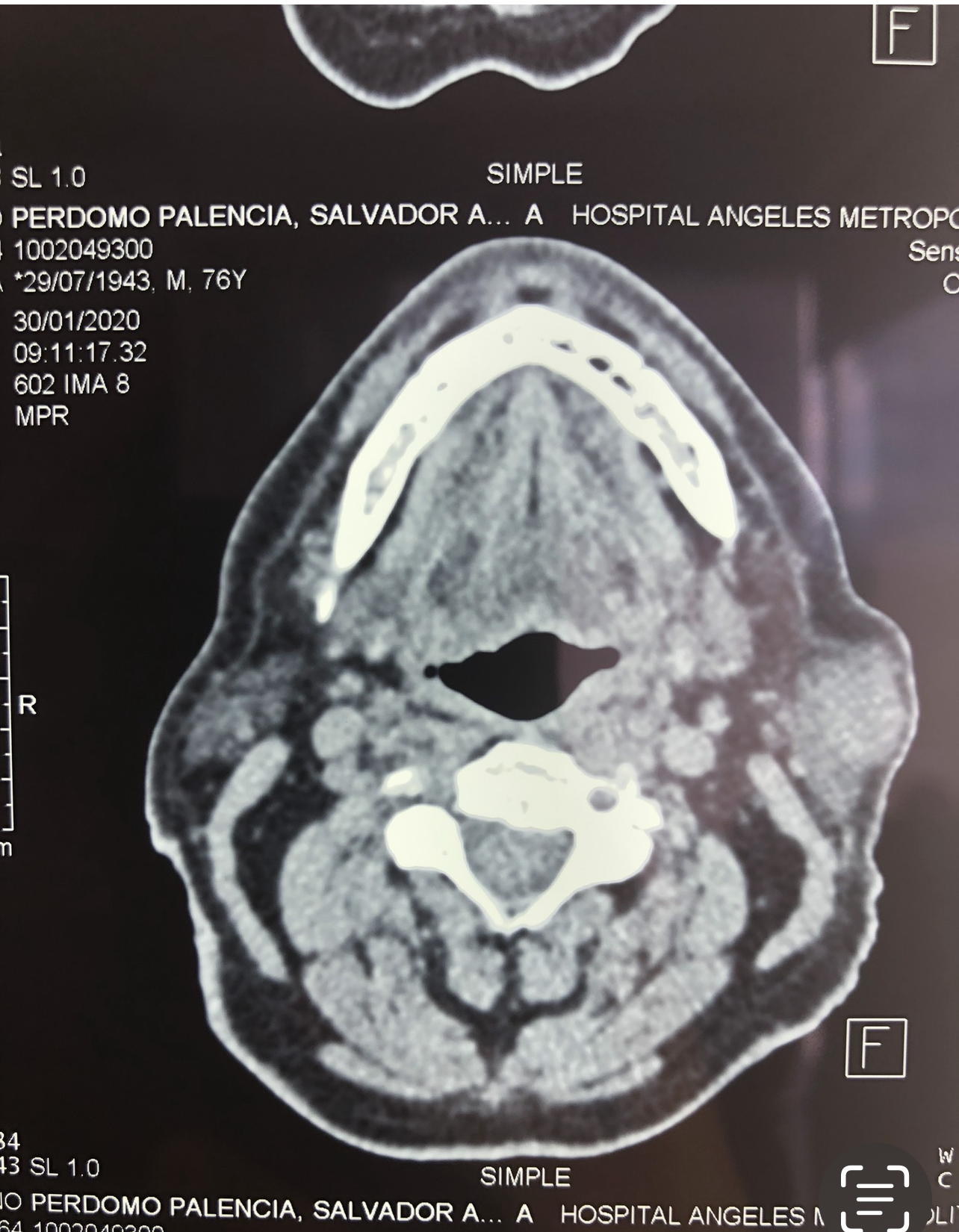 Case: Parotid Tumor