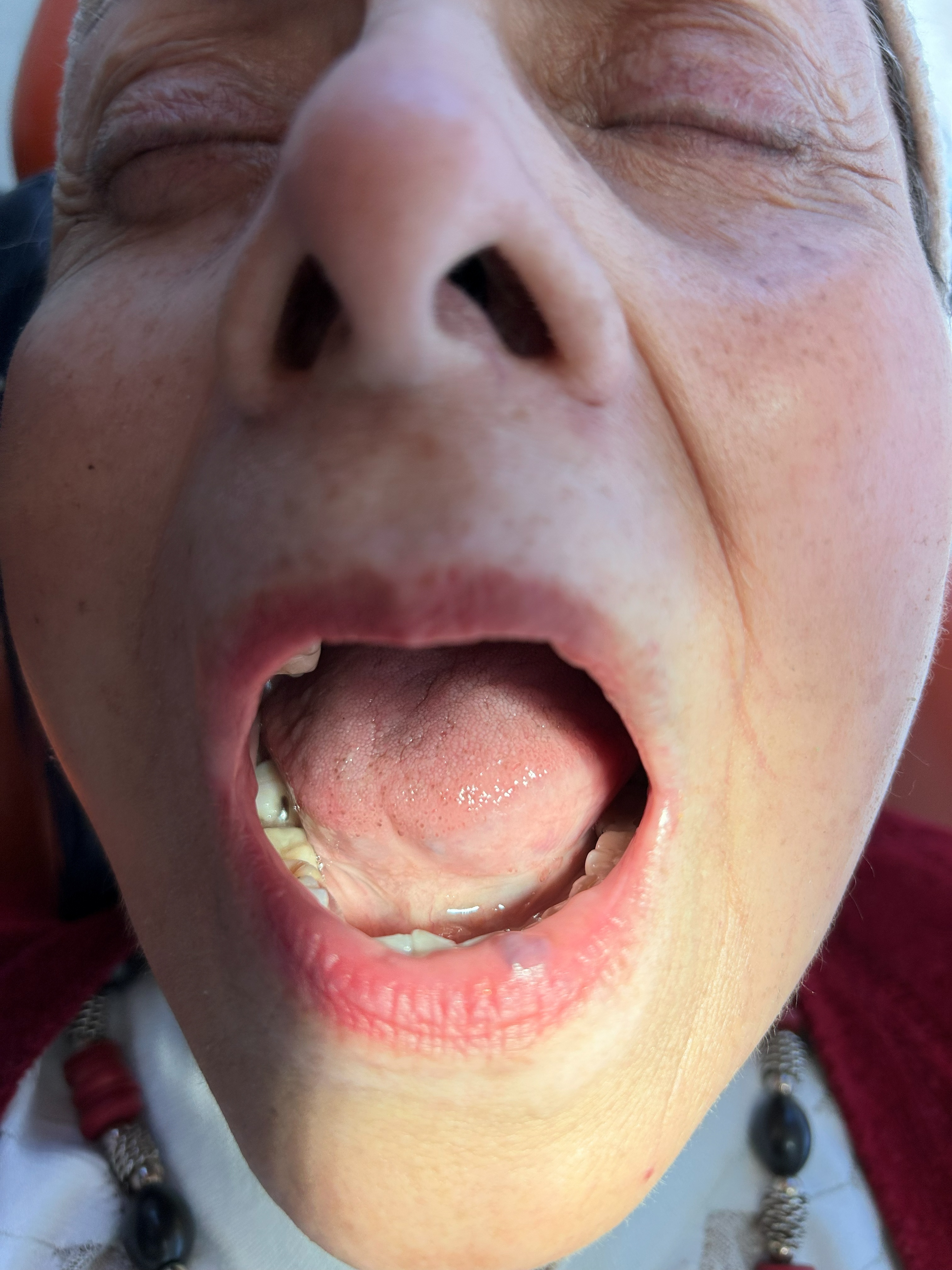 Hemangioma labial (caso clínico)