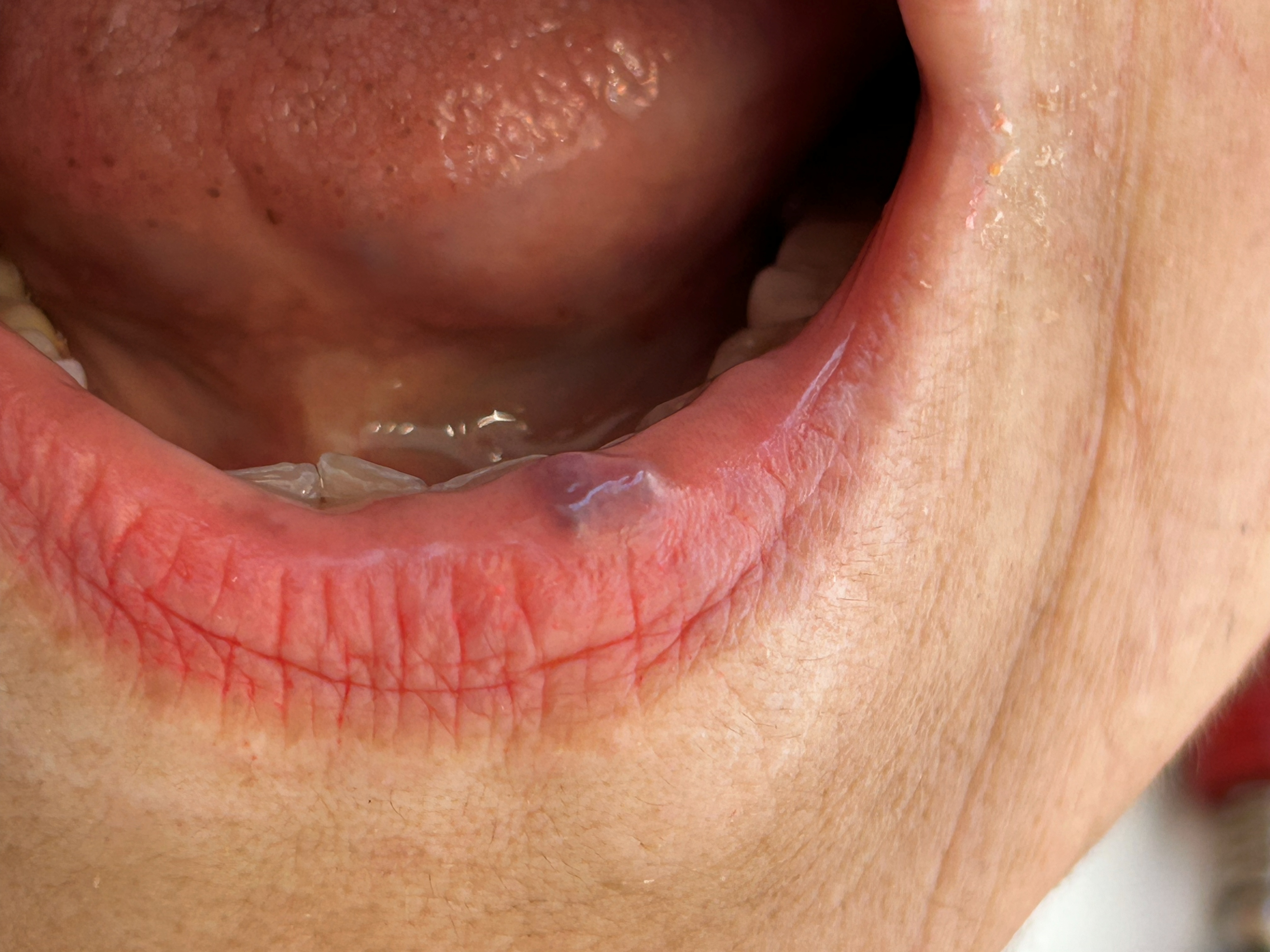 Hemangioma labial (caso clínico)