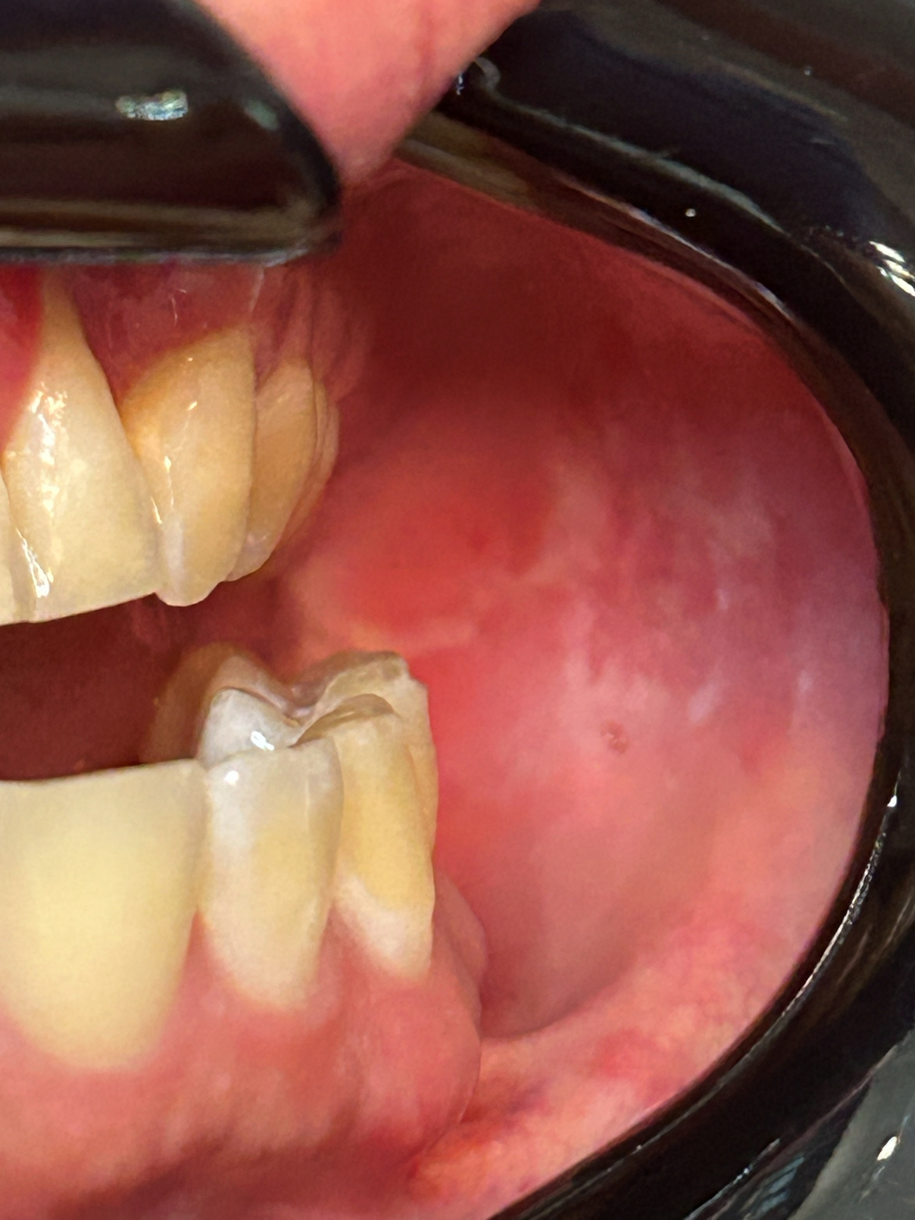 Leucoplasia: caso clínico