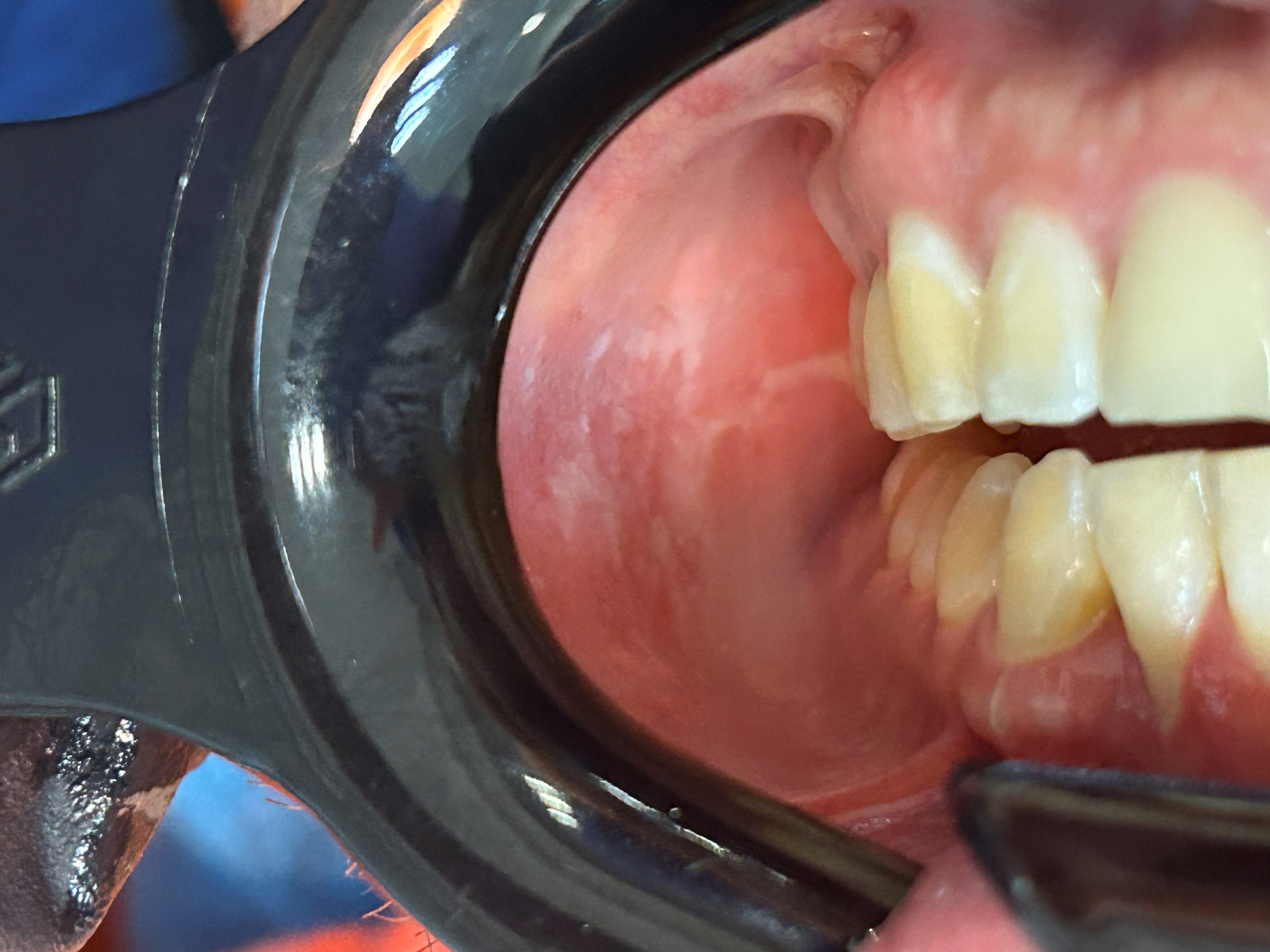 Leucoplasia: caso clínico