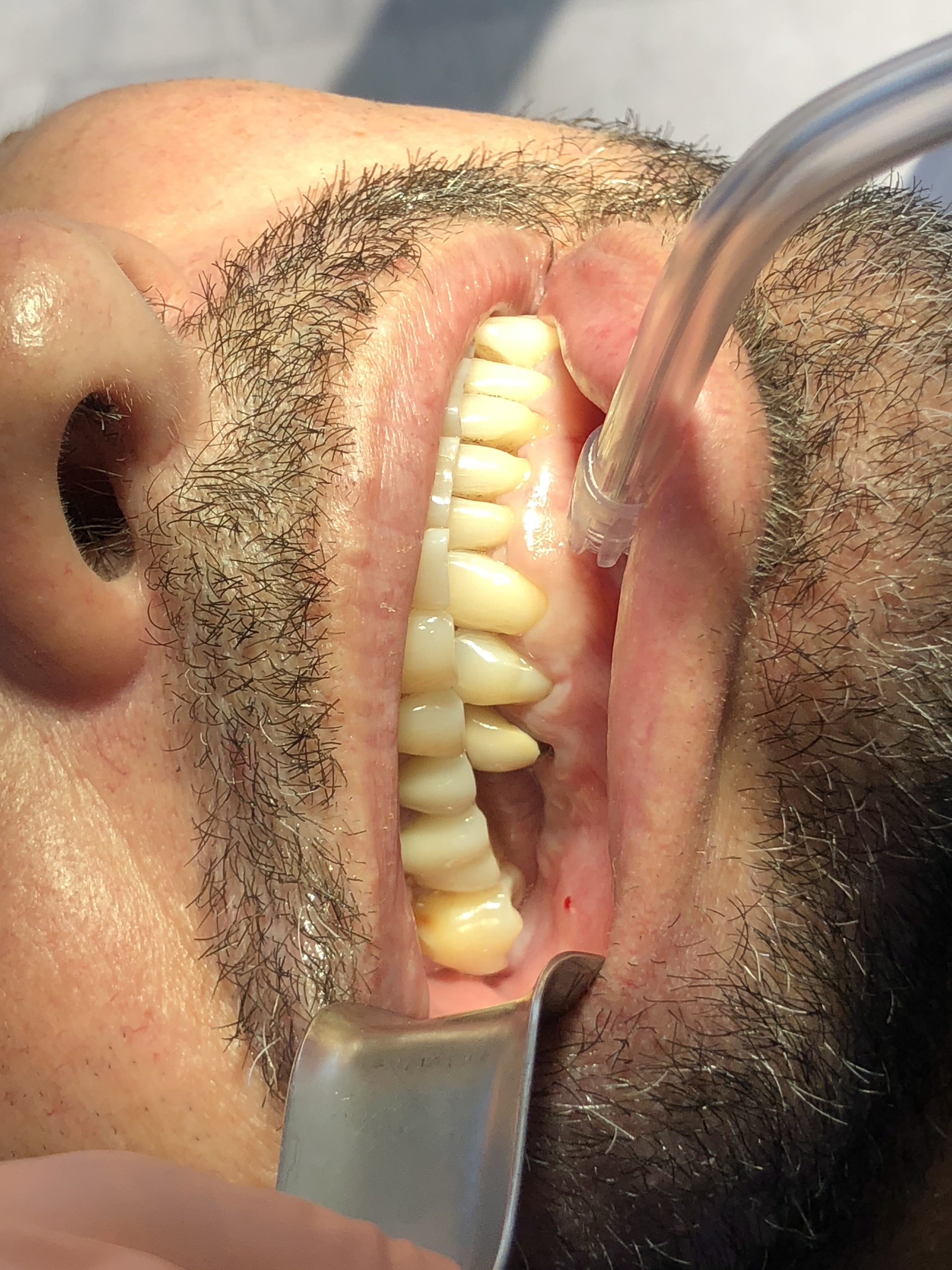 Tooth loss and bite collapse