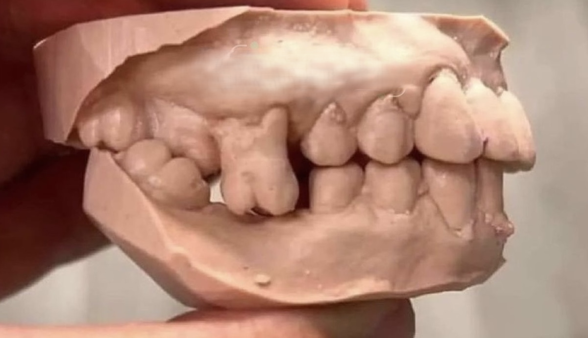 Overeruption due to missing opposing tooth
