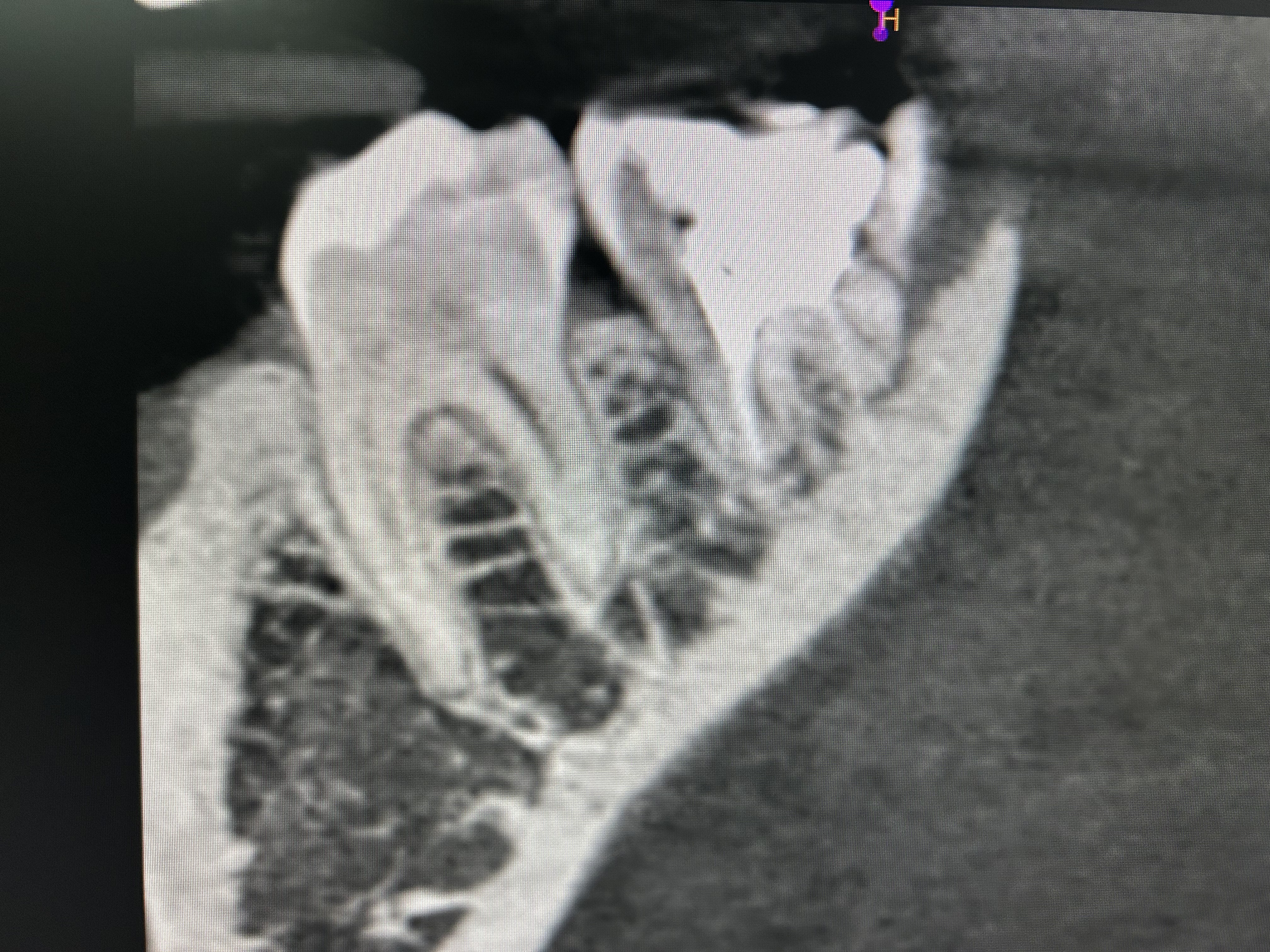 Fractura vertical dental