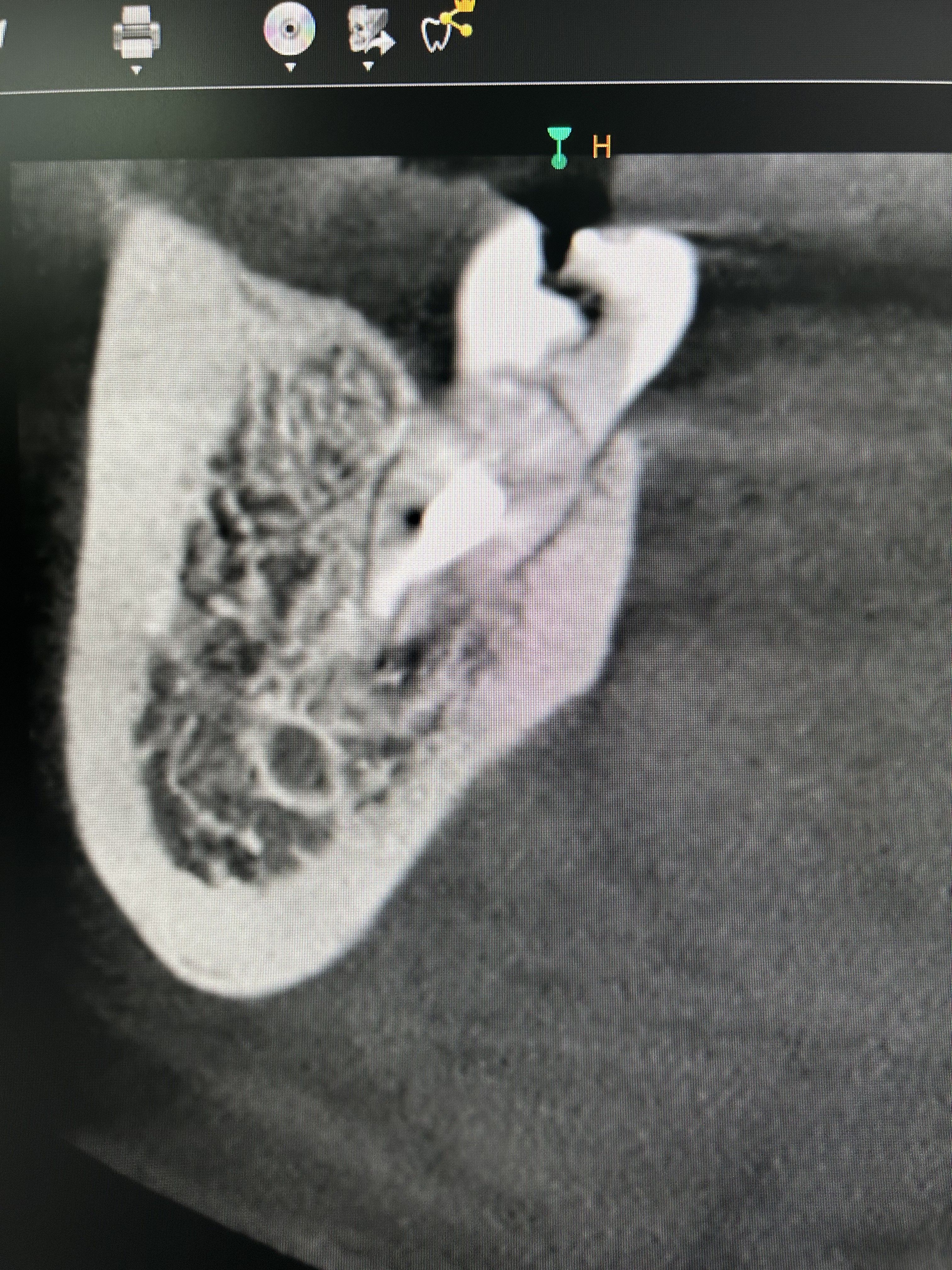 Fractura vertical dental