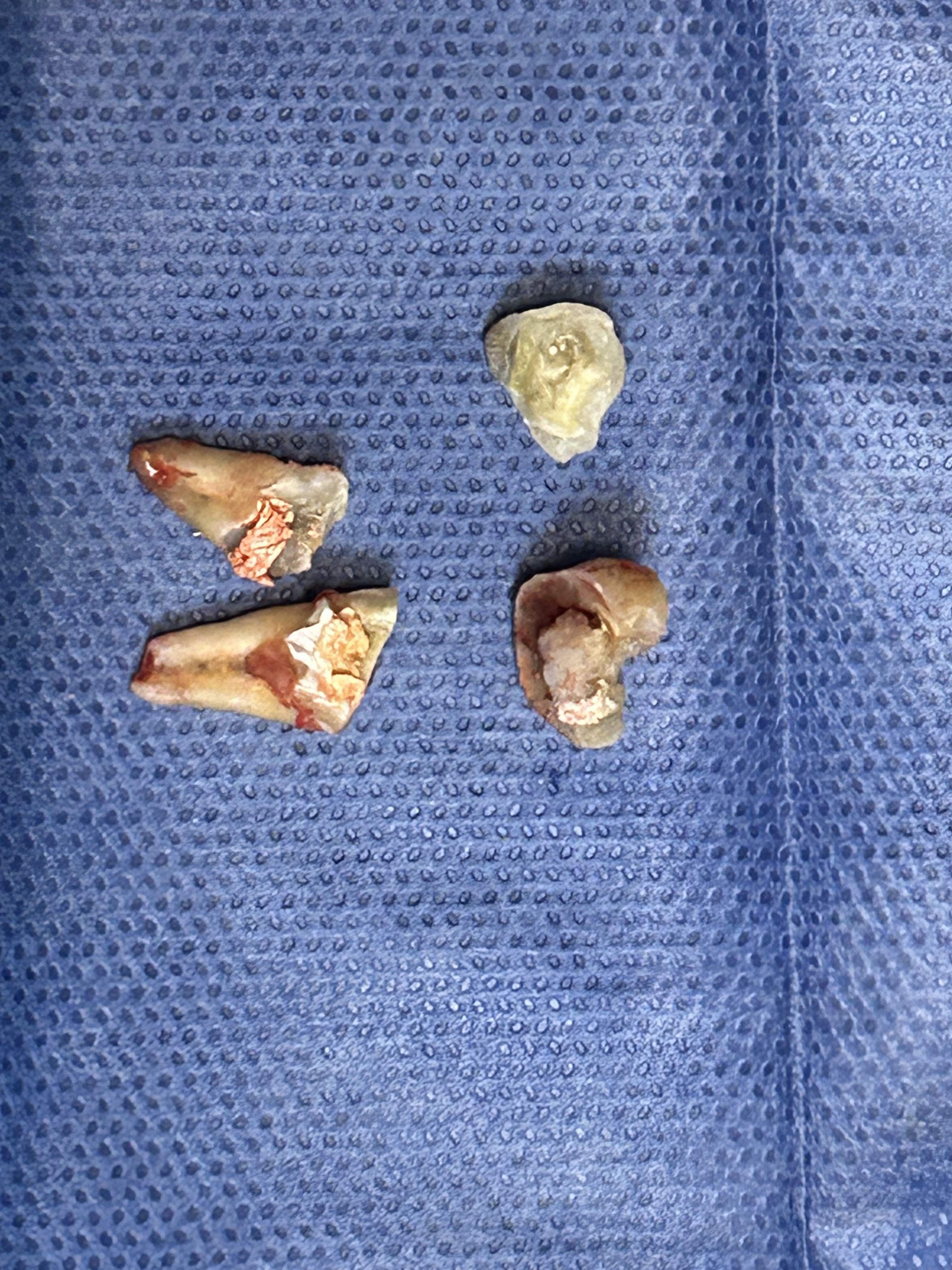 Fractura vertical dental
