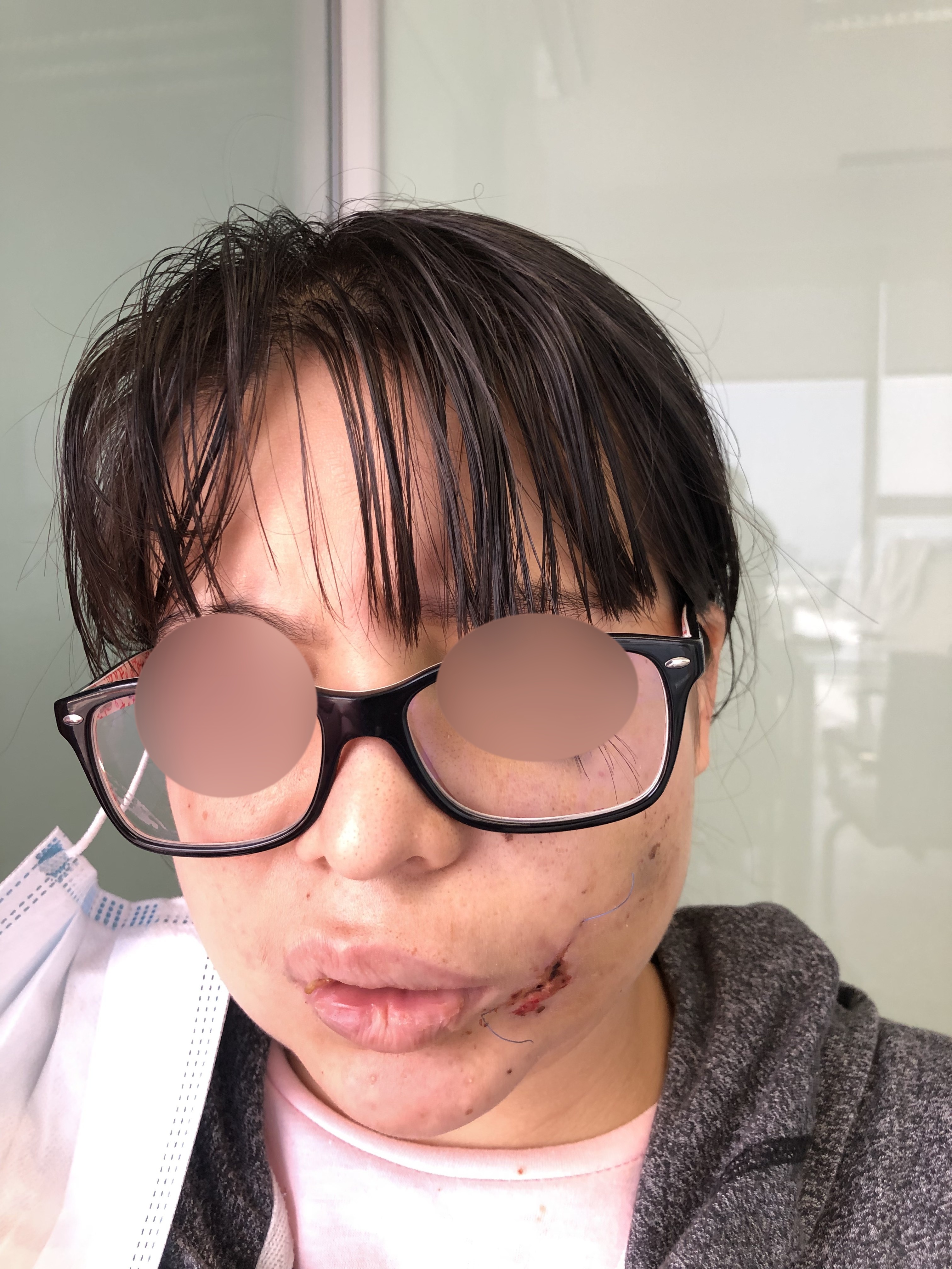 Mordida de perro: lesión de nervio facial