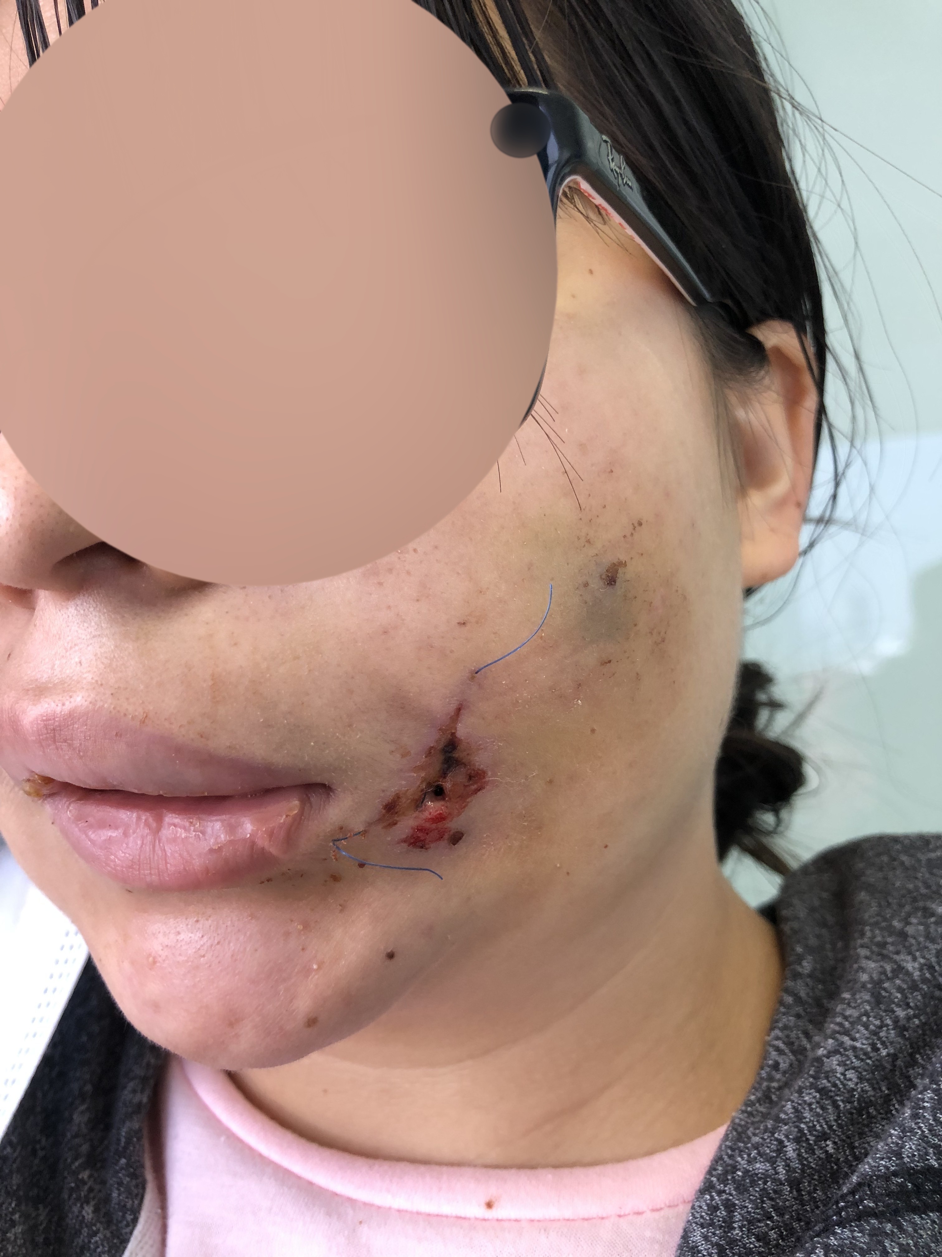 Mordida de perro: lesión de nervio facial