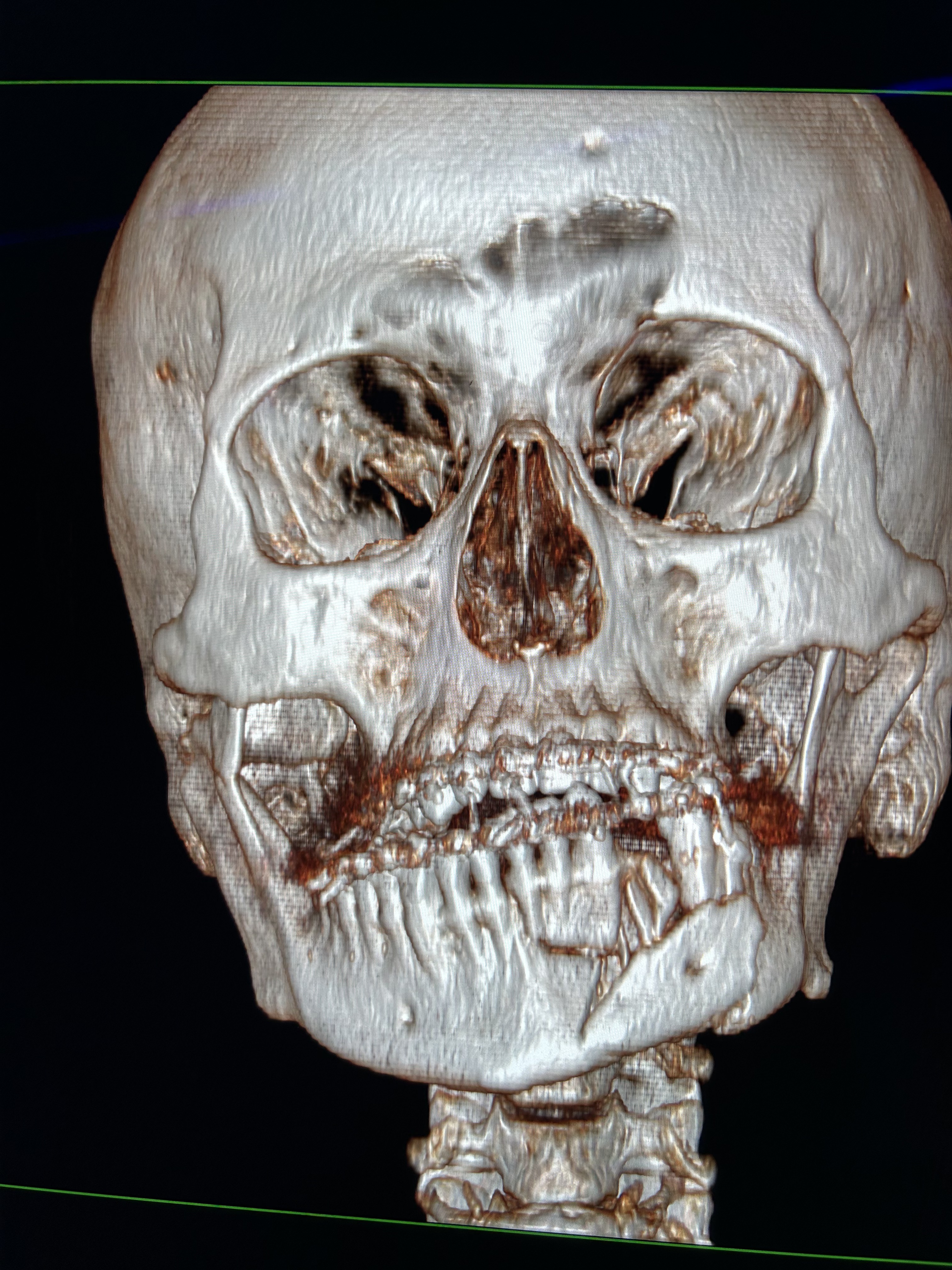 Fractura de cóndilo y mandíbula