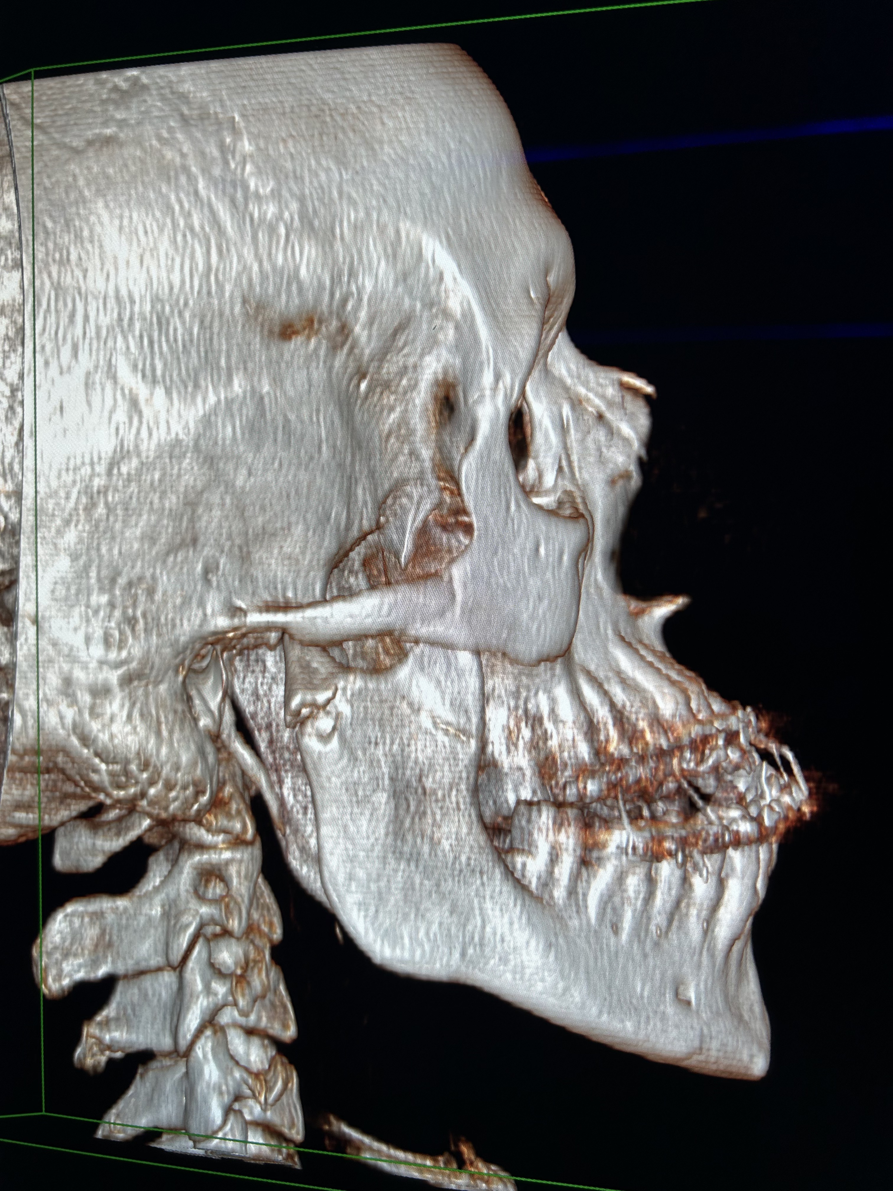 Fractura de cóndilo y mandíbula