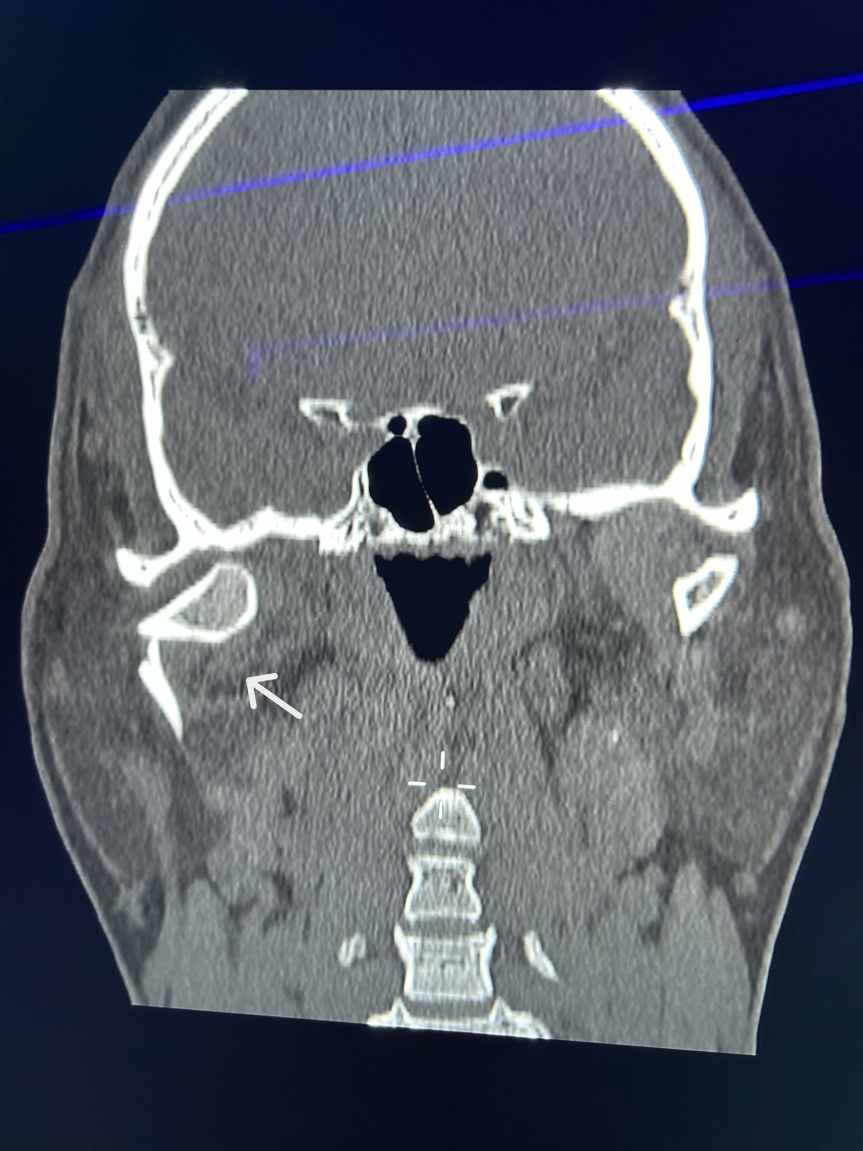 Fractura de cóndilo y mandíbula