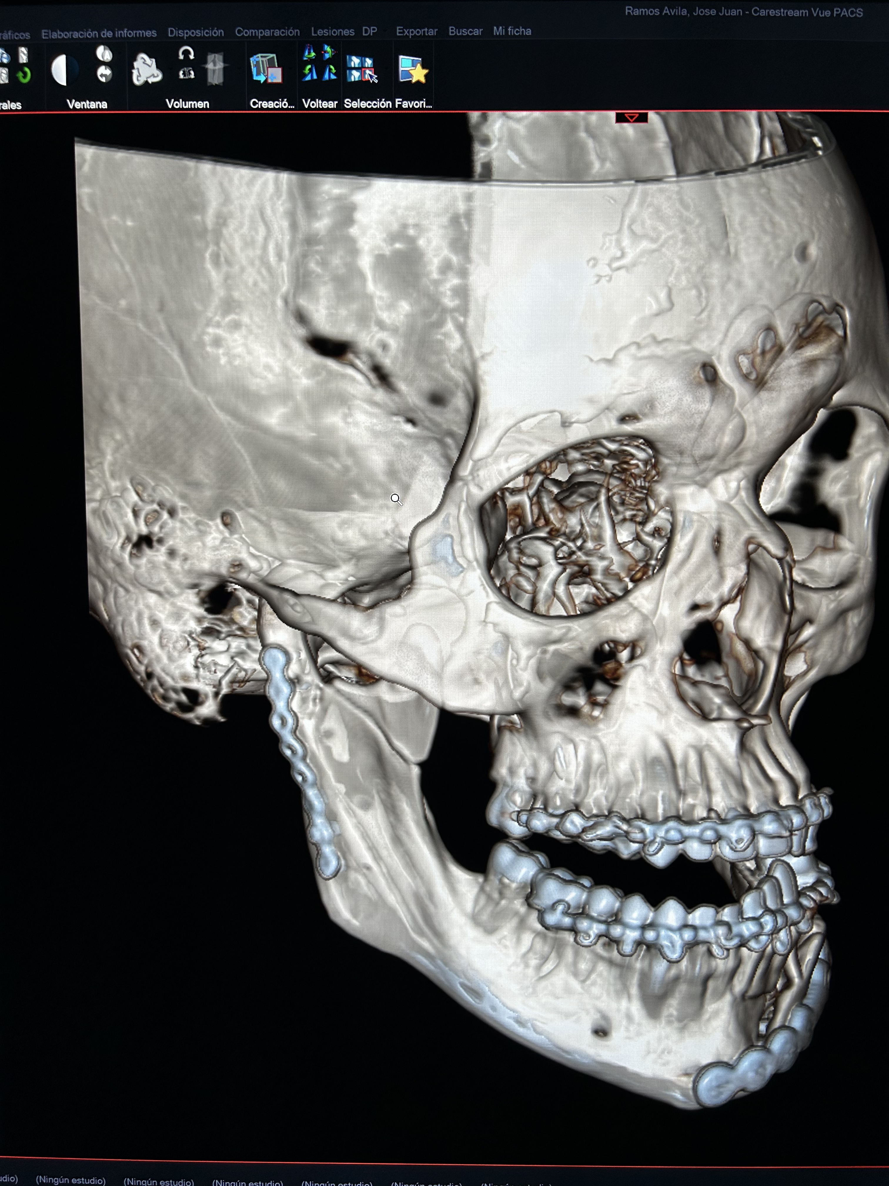 Fractura de cóndilo y mandíbula