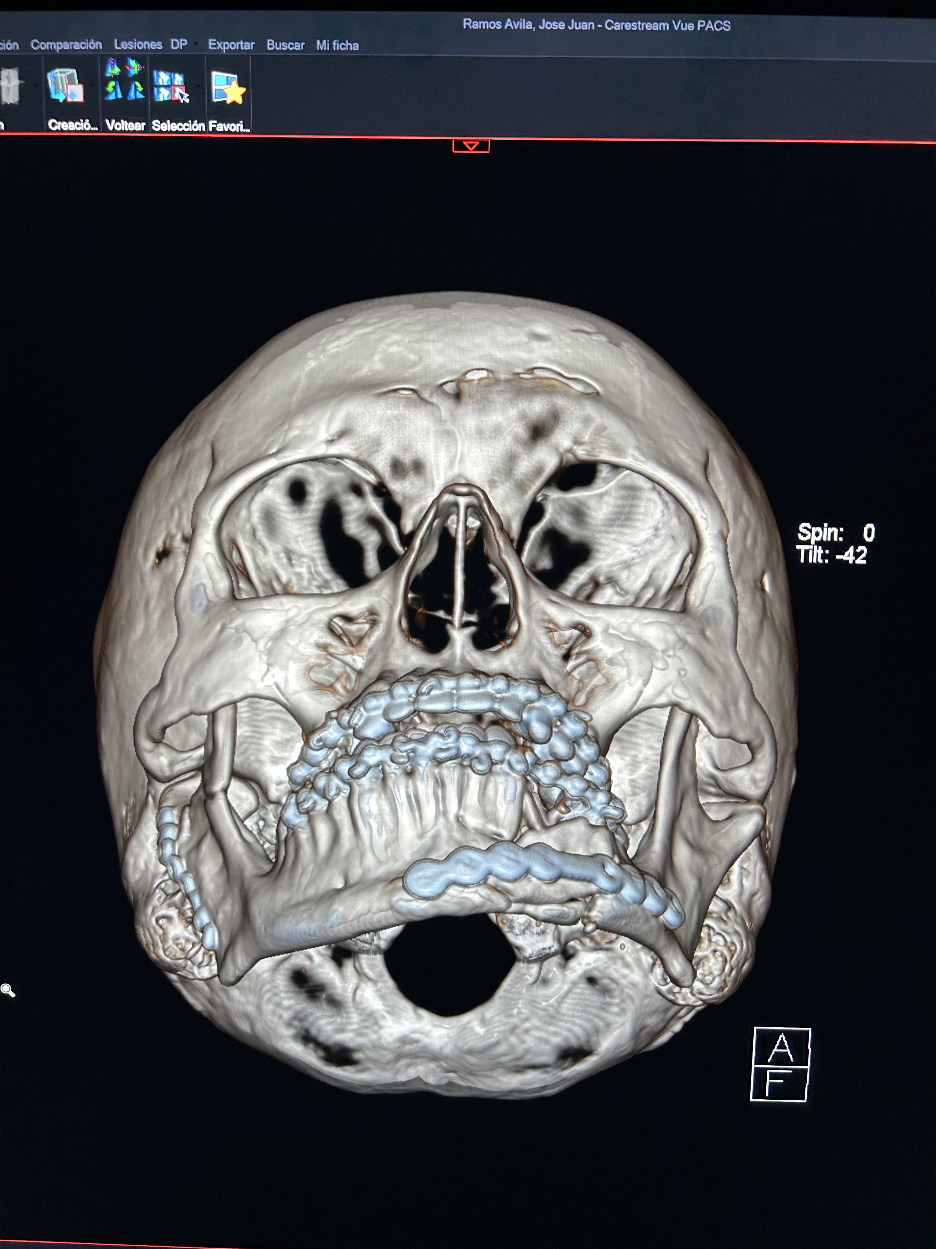 Fractura de cóndilo y mandíbula