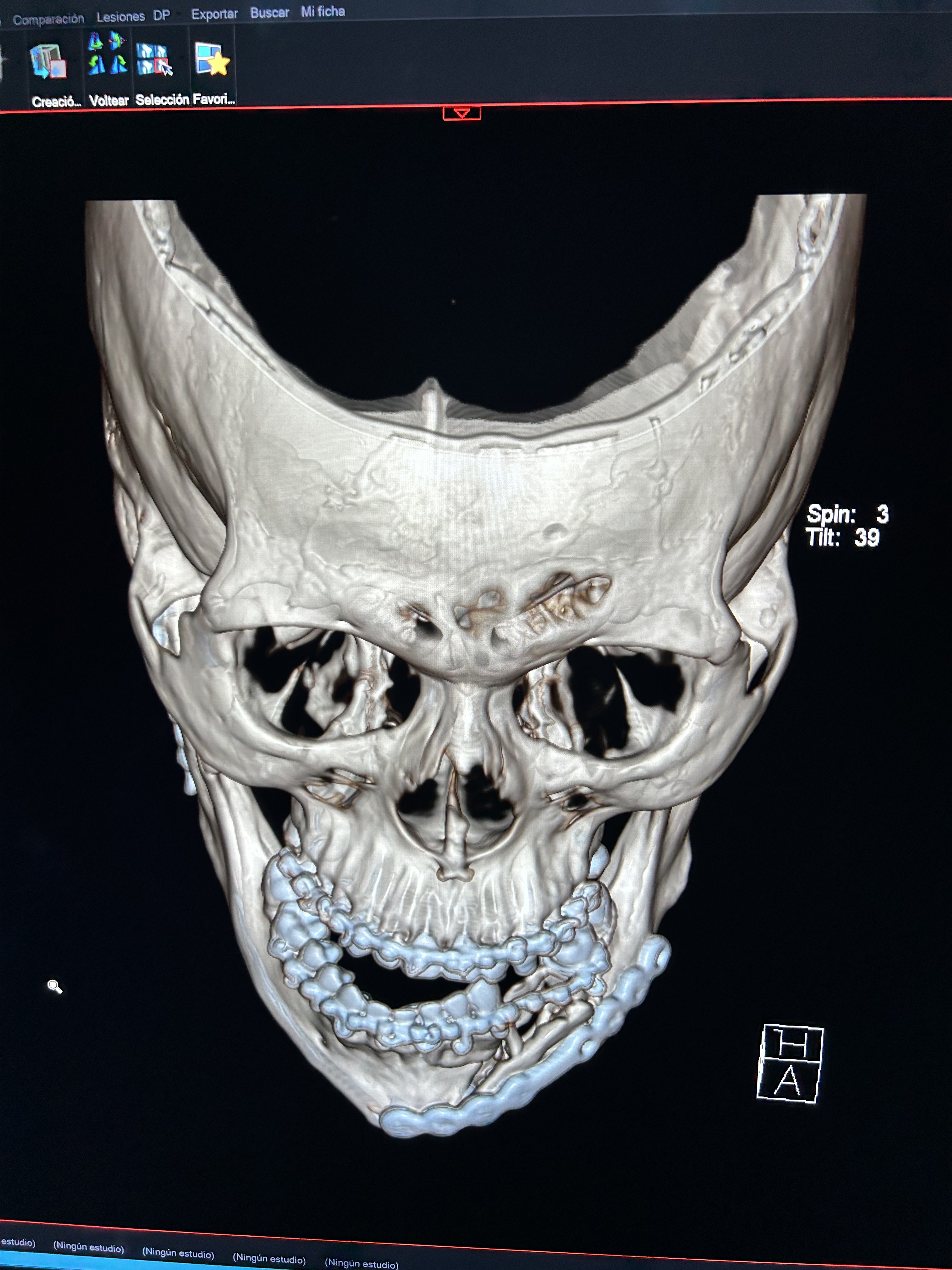 Fractura de cóndilo y mandíbula