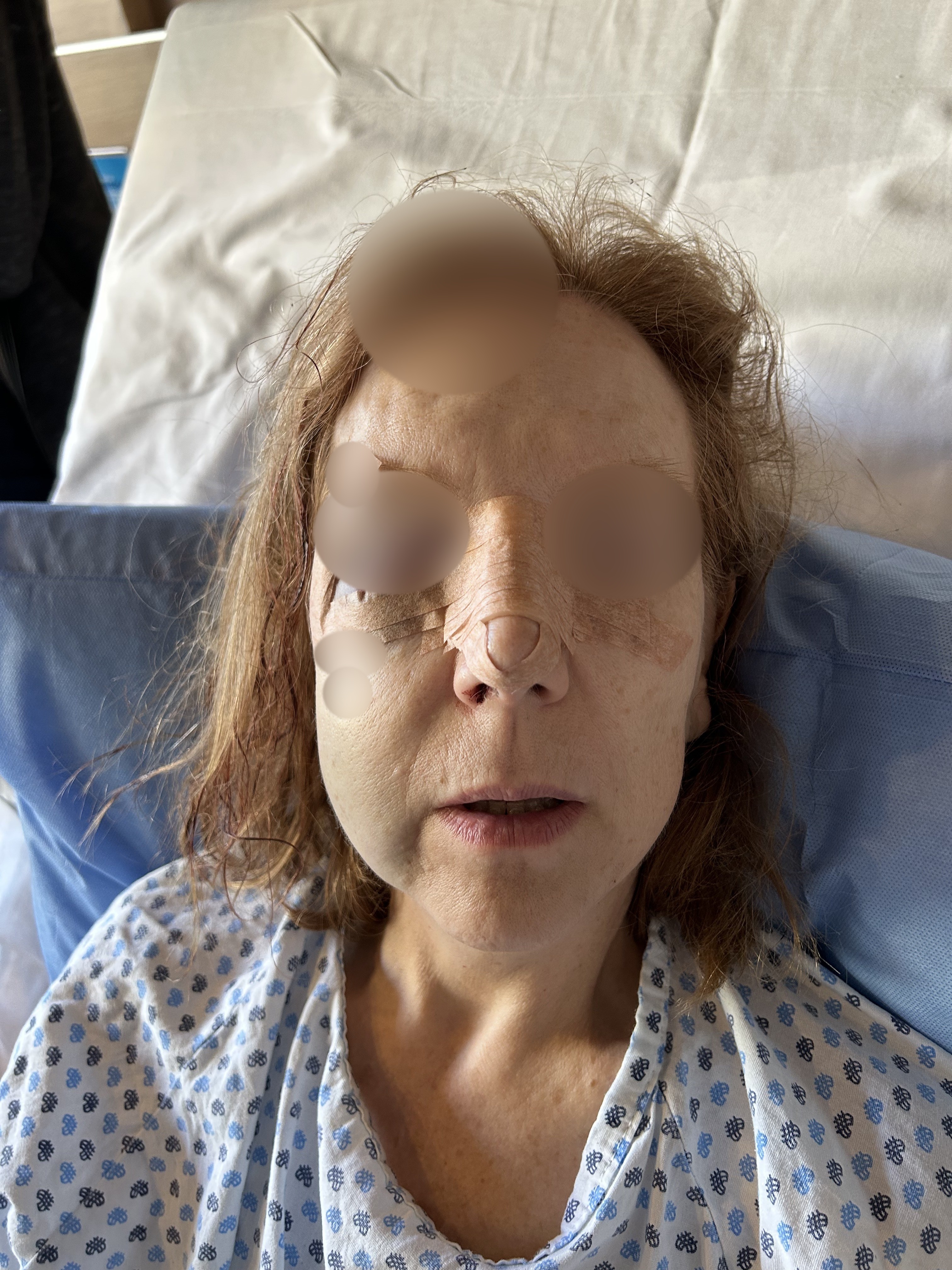 Fractura de piso de órbita (abordaje transconjuntival)