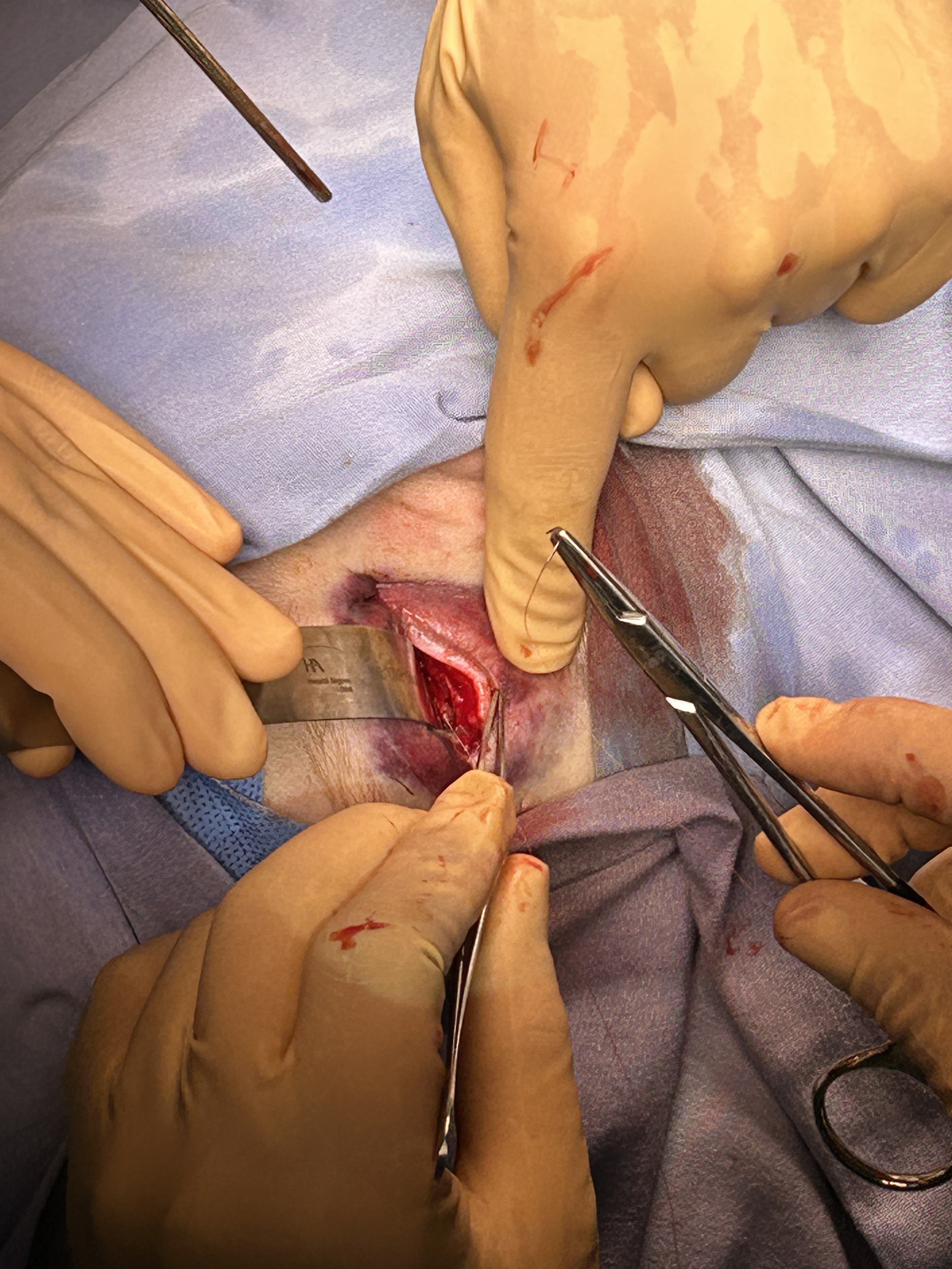 Fractura de piso de órbita (abordaje transconjuntival)